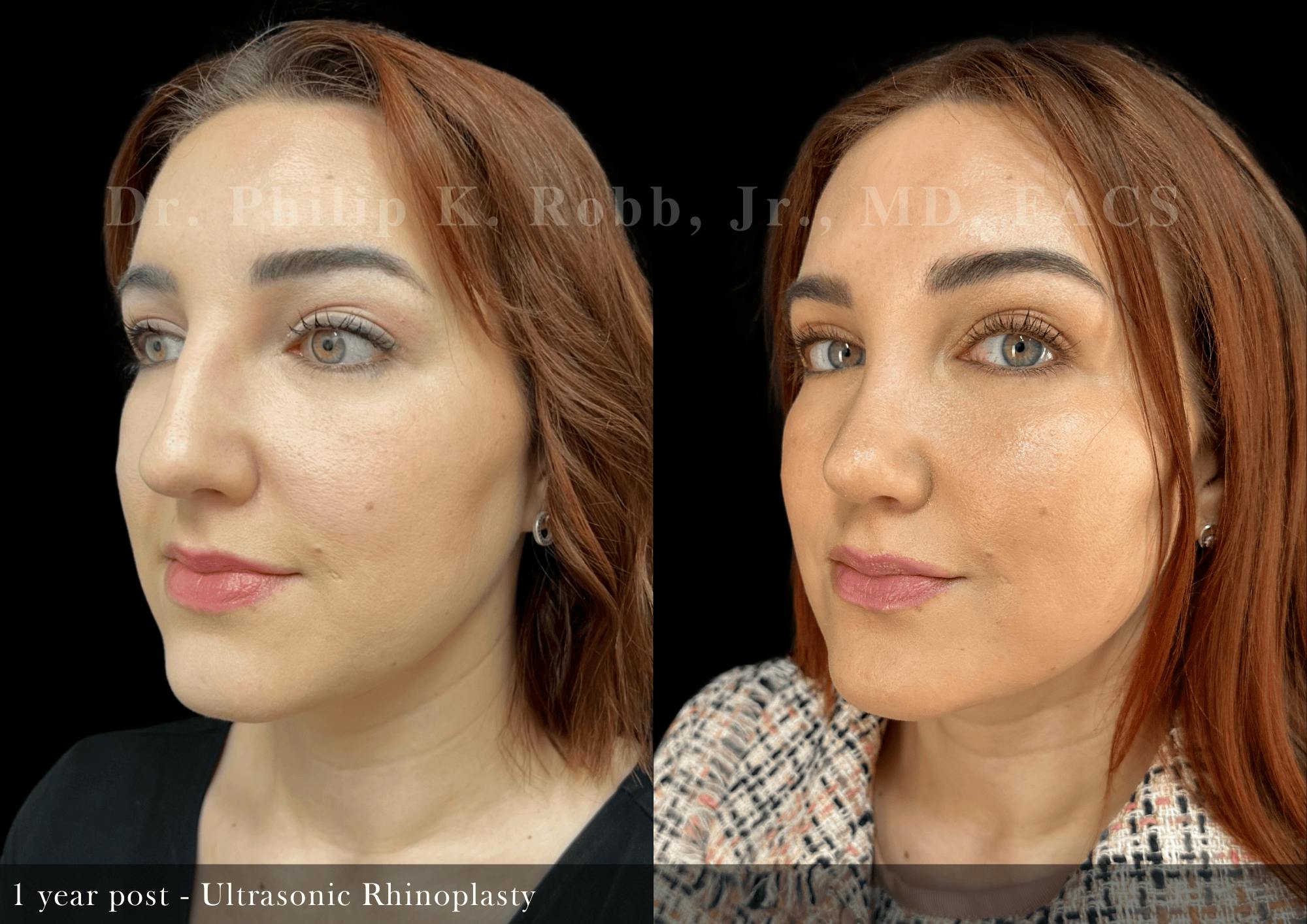 Ultrasonic Rhinoplasty Before & After Gallery - Patient 146676 - Image 4