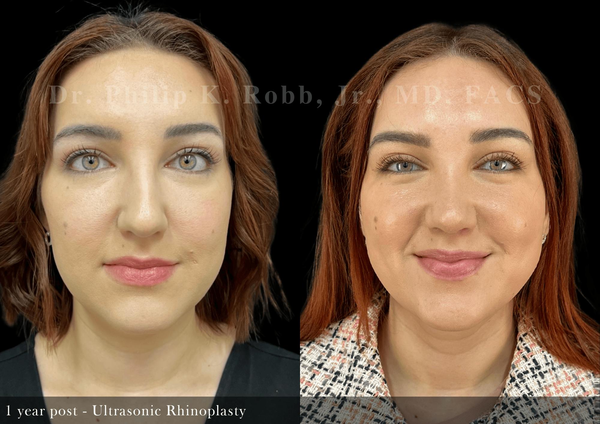 Ultrasonic Rhinoplasty Before & After Gallery - Patient 146676 - Image 3