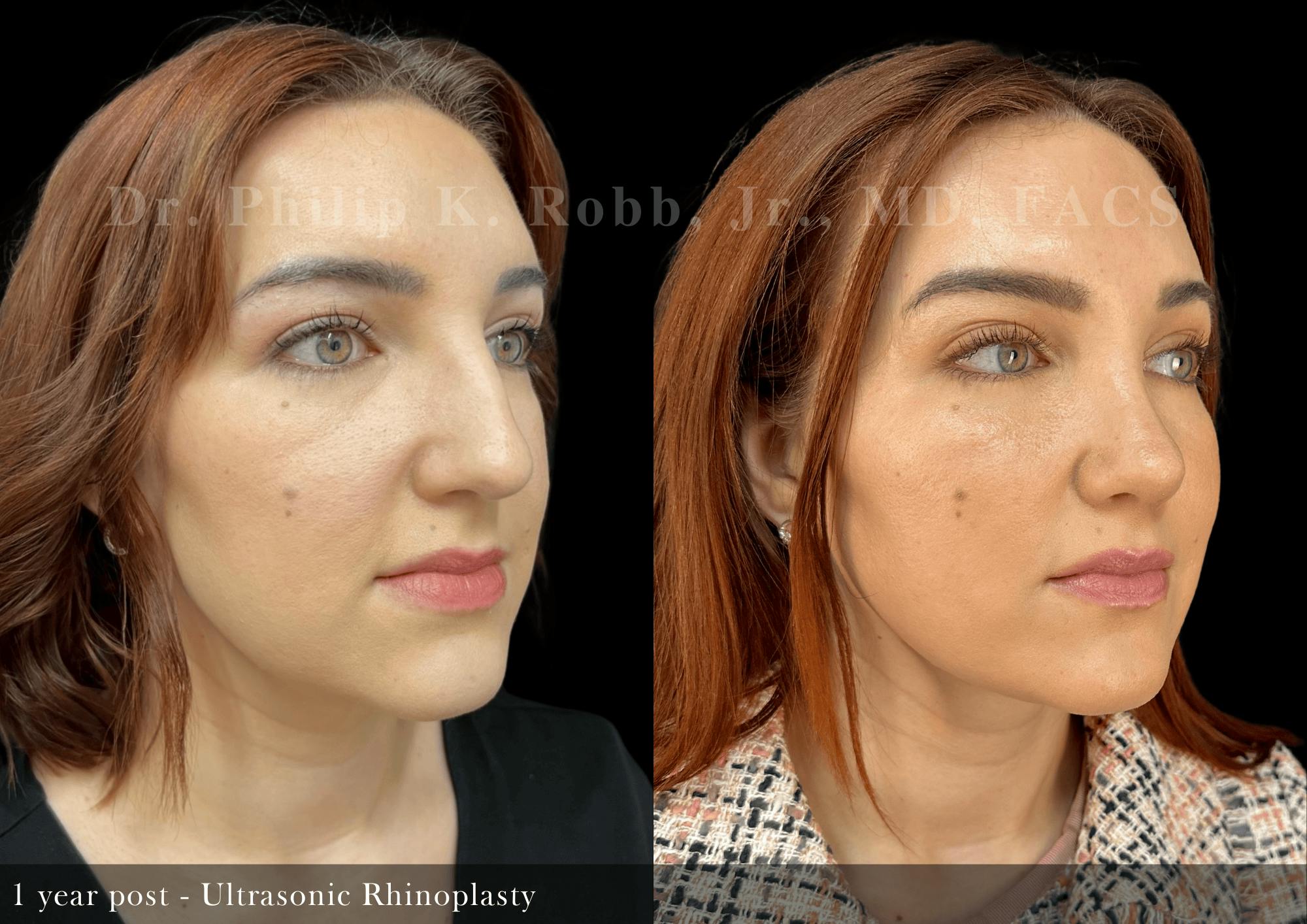 Ultrasonic Rhinoplasty Before & After Gallery - Patient 146676 - Image 2