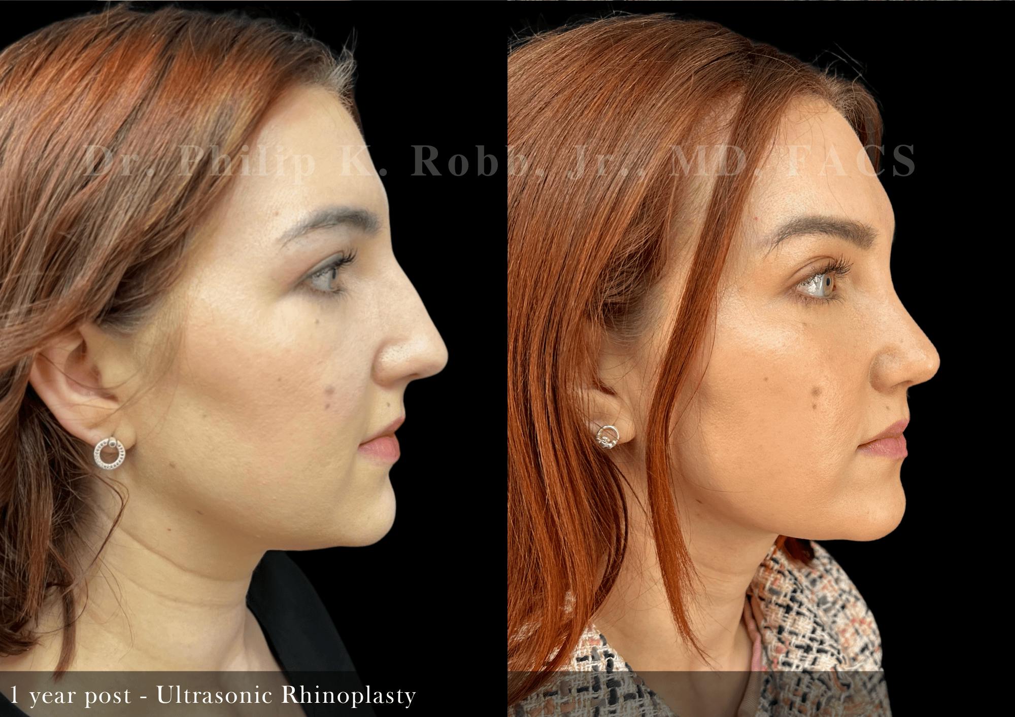 Ultrasonic Rhinoplasty Before & After Gallery - Patient 146676 - Image 1