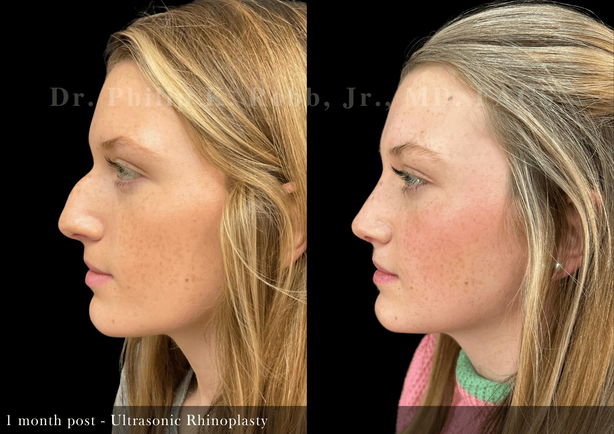Ultrasonic Rhinoplasty Before & After Gallery - Patient 163149 - Image 5