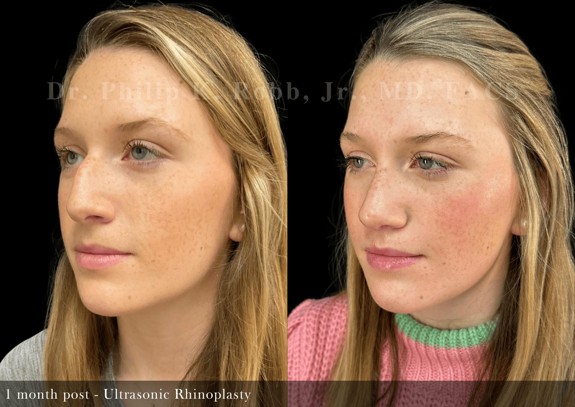 Ultrasonic Rhinoplasty Before & After Gallery - Patient 163149 - Image 4
