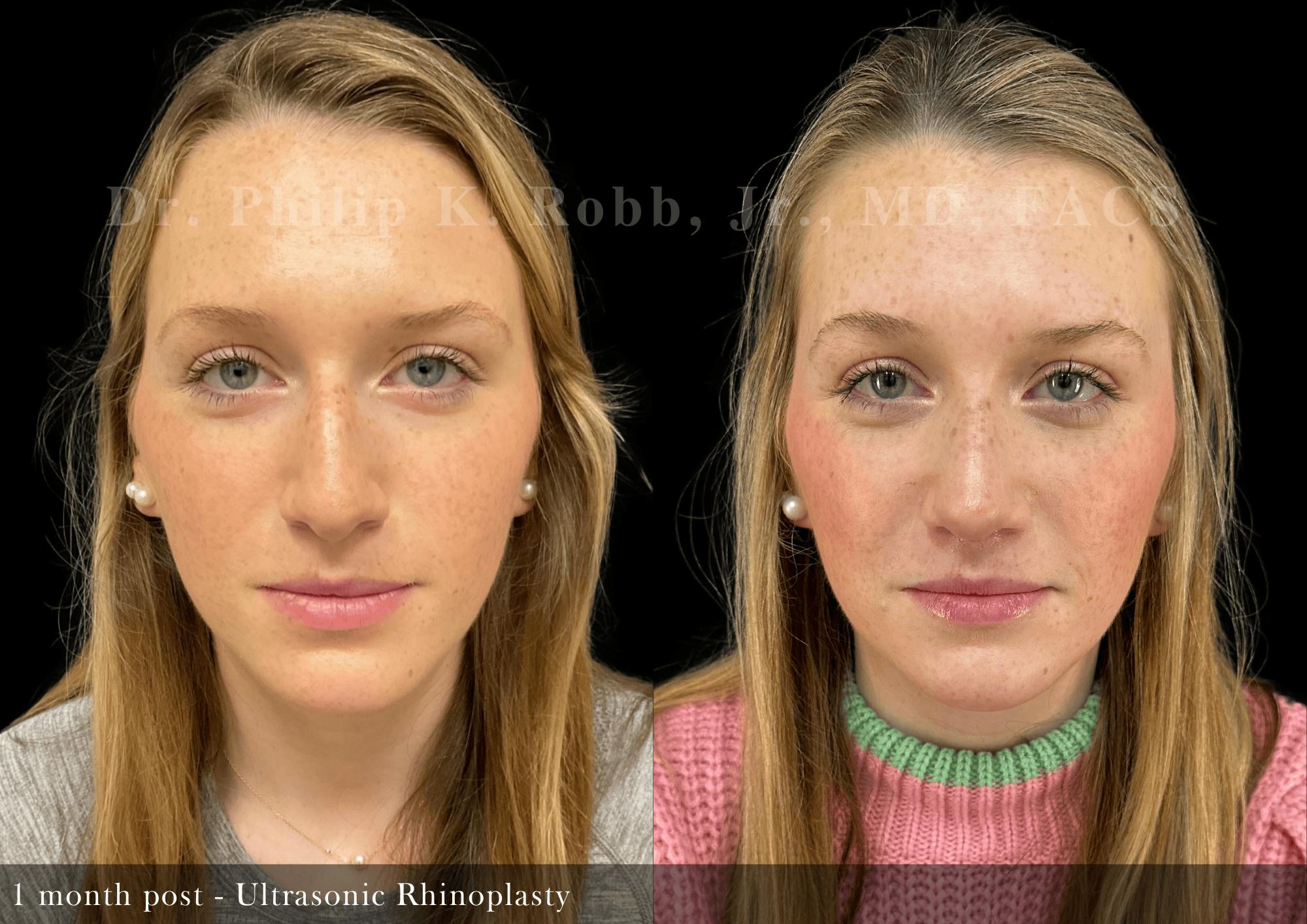 Ultrasonic Rhinoplasty Before & After Gallery - Patient 163149 - Image 3
