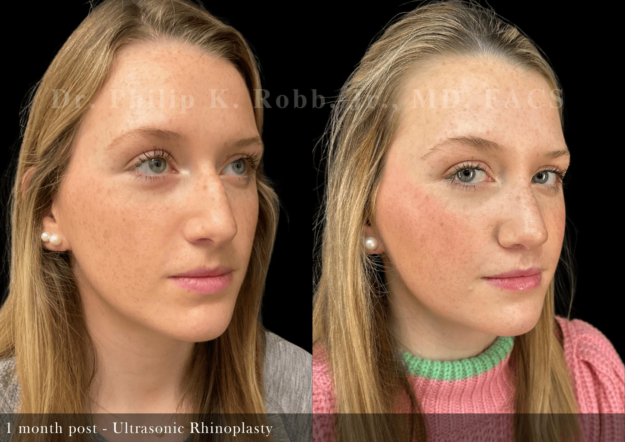 Ultrasonic Rhinoplasty Before & After Gallery - Patient 163149 - Image 2