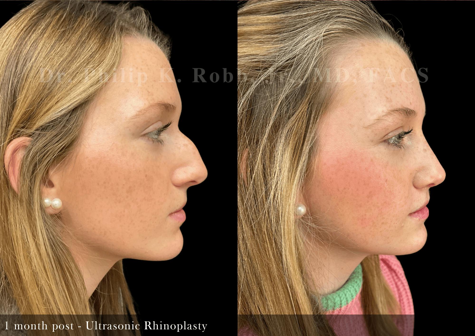Ultrasonic Rhinoplasty Before & After Gallery - Patient 163149 - Image 1