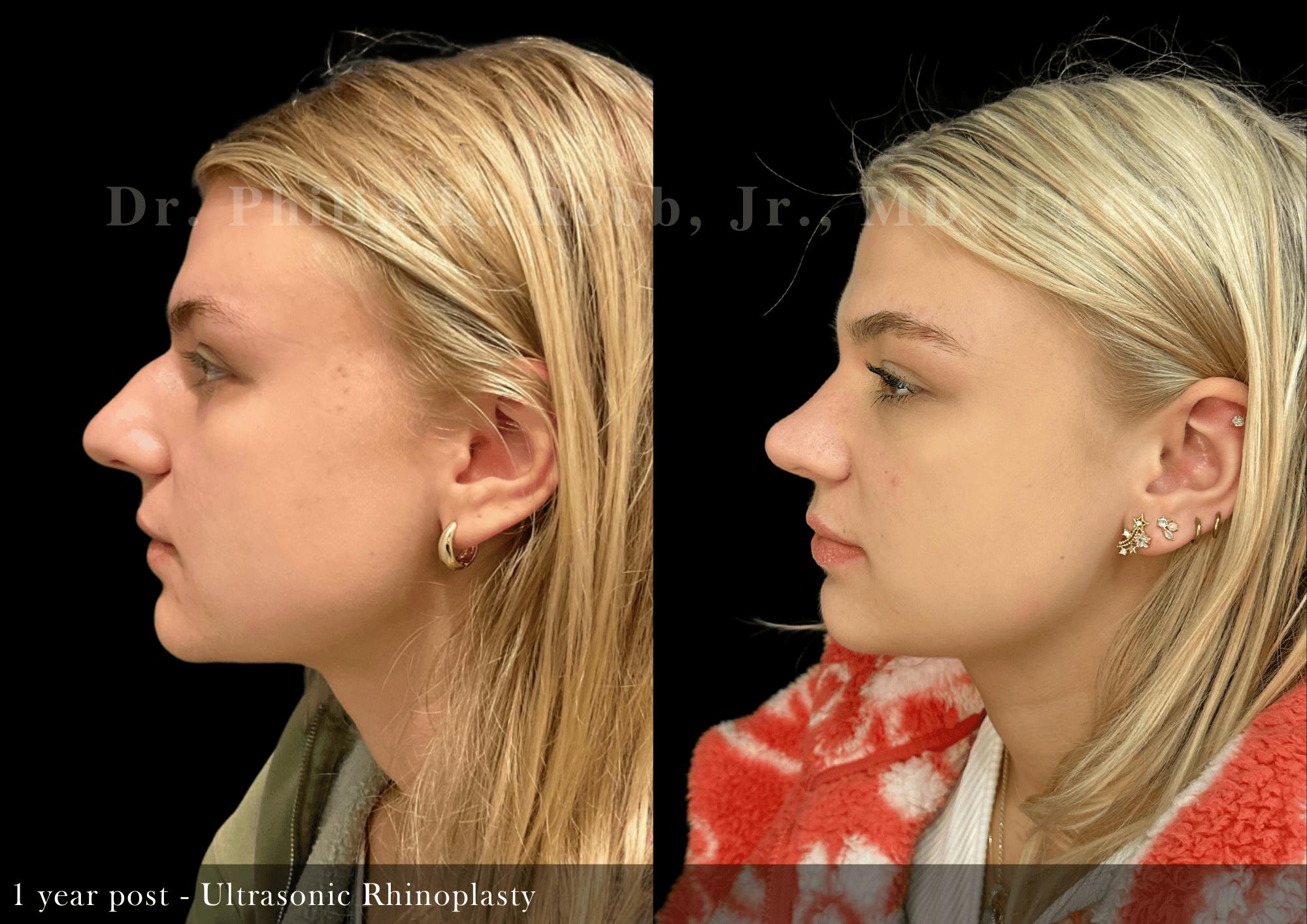 Ultrasonic Rhinoplasty Before & After Gallery - Patient 395923 - Image 5