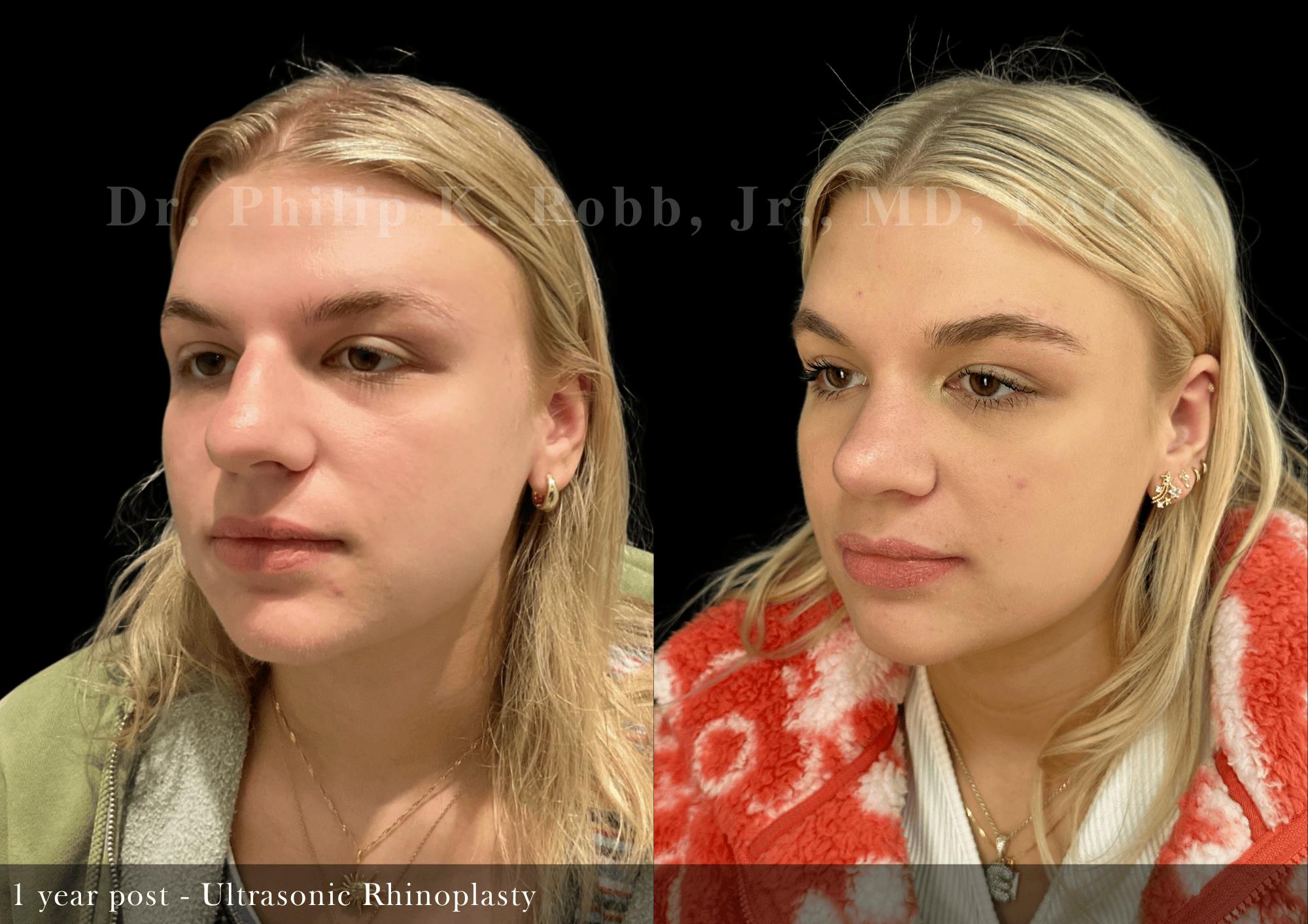 Ultrasonic Rhinoplasty Before & After Gallery - Patient 395923 - Image 4