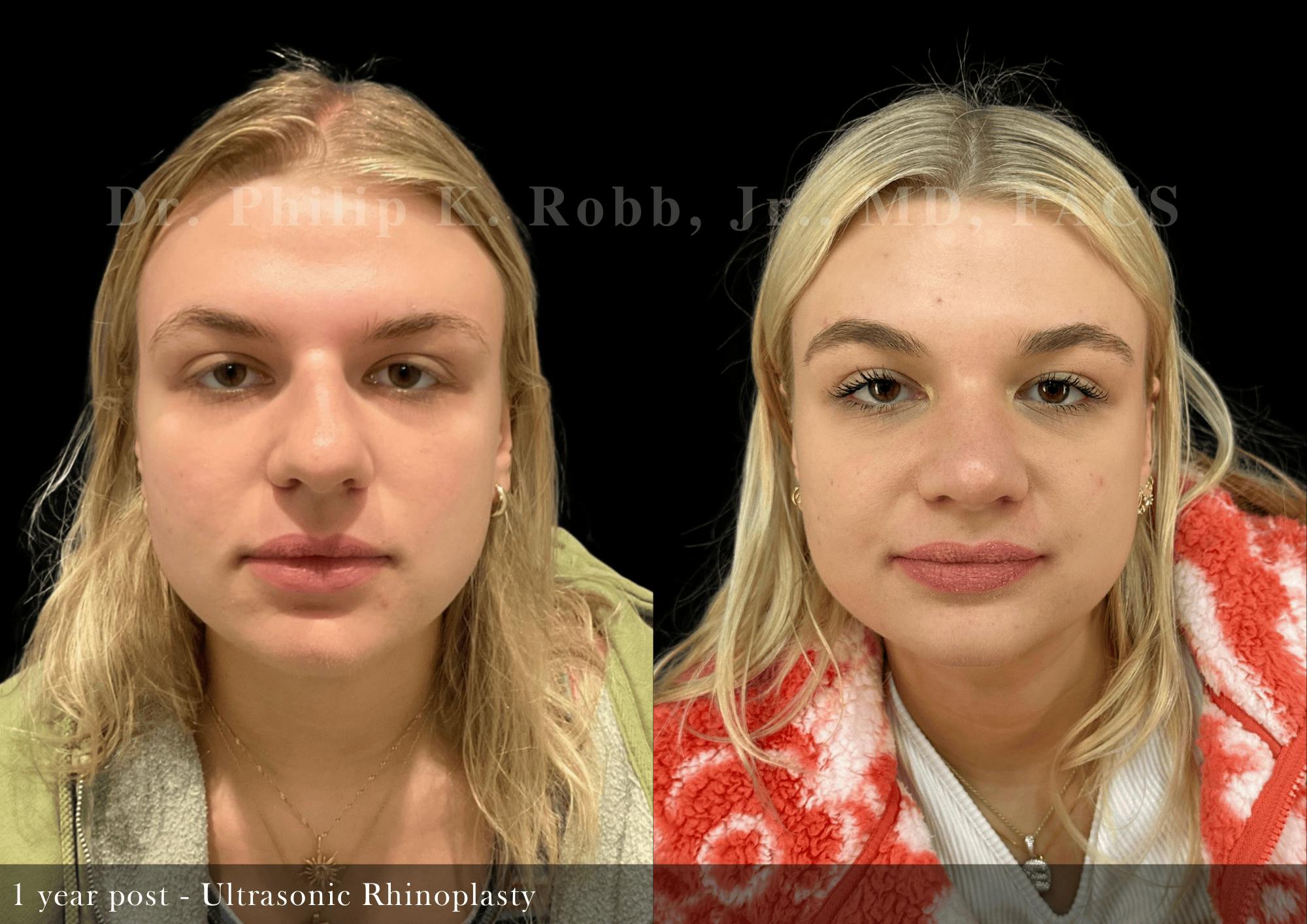 Ultrasonic Rhinoplasty Before & After Gallery - Patient 395923 - Image 3