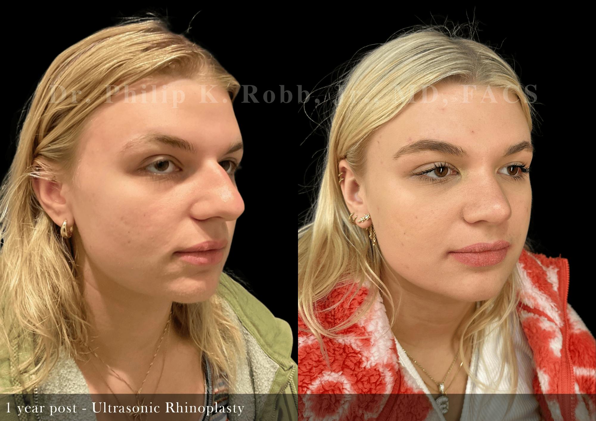 Ultrasonic Rhinoplasty Before & After Gallery - Patient 395923 - Image 2