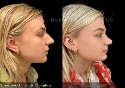 Ultrasonic Rhinoplasty Before & After Gallery - Patient 395923 - Image 1