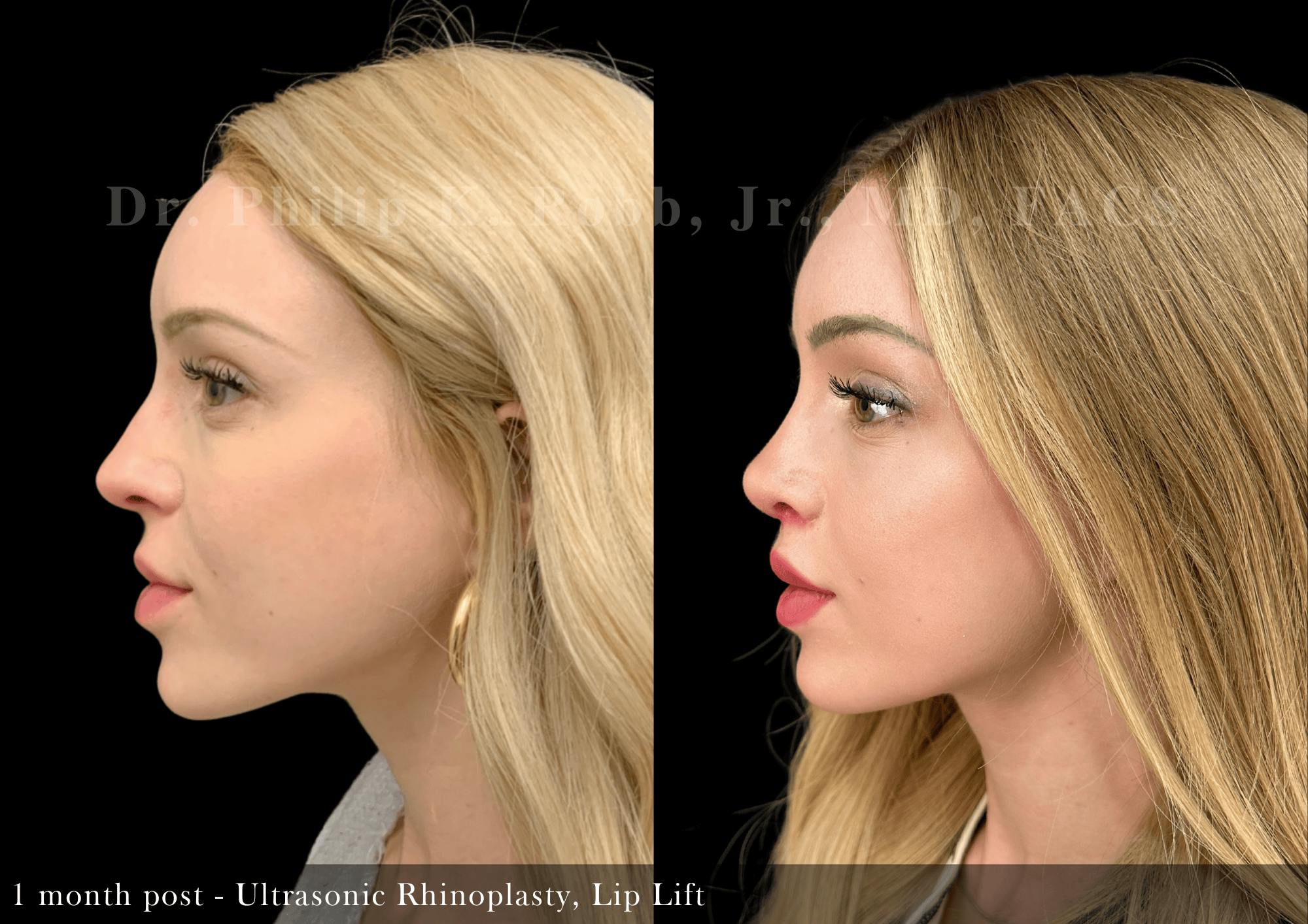 Lip Lift Before & After Gallery - Patient 236385 - Image 2