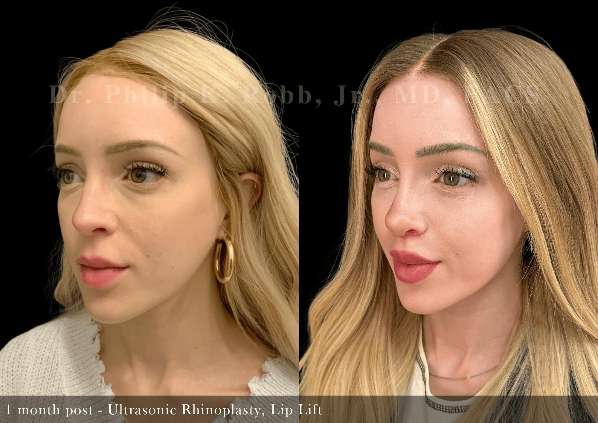 Ultrasonic Rhinoplasty Before & After Gallery - Patient 241673 - Image 4