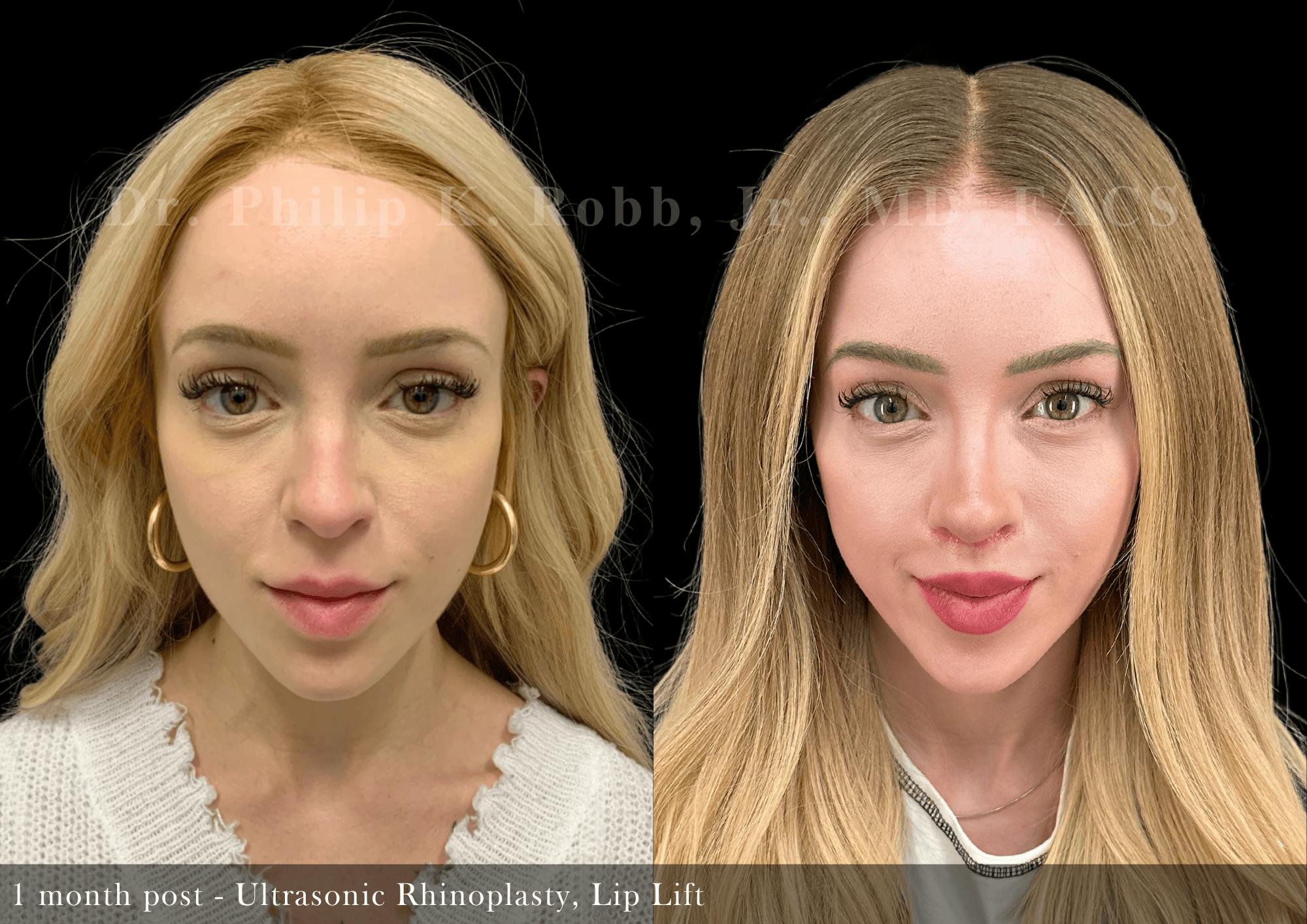 Ultrasonic Rhinoplasty Before & After Gallery - Patient 241673 - Image 3