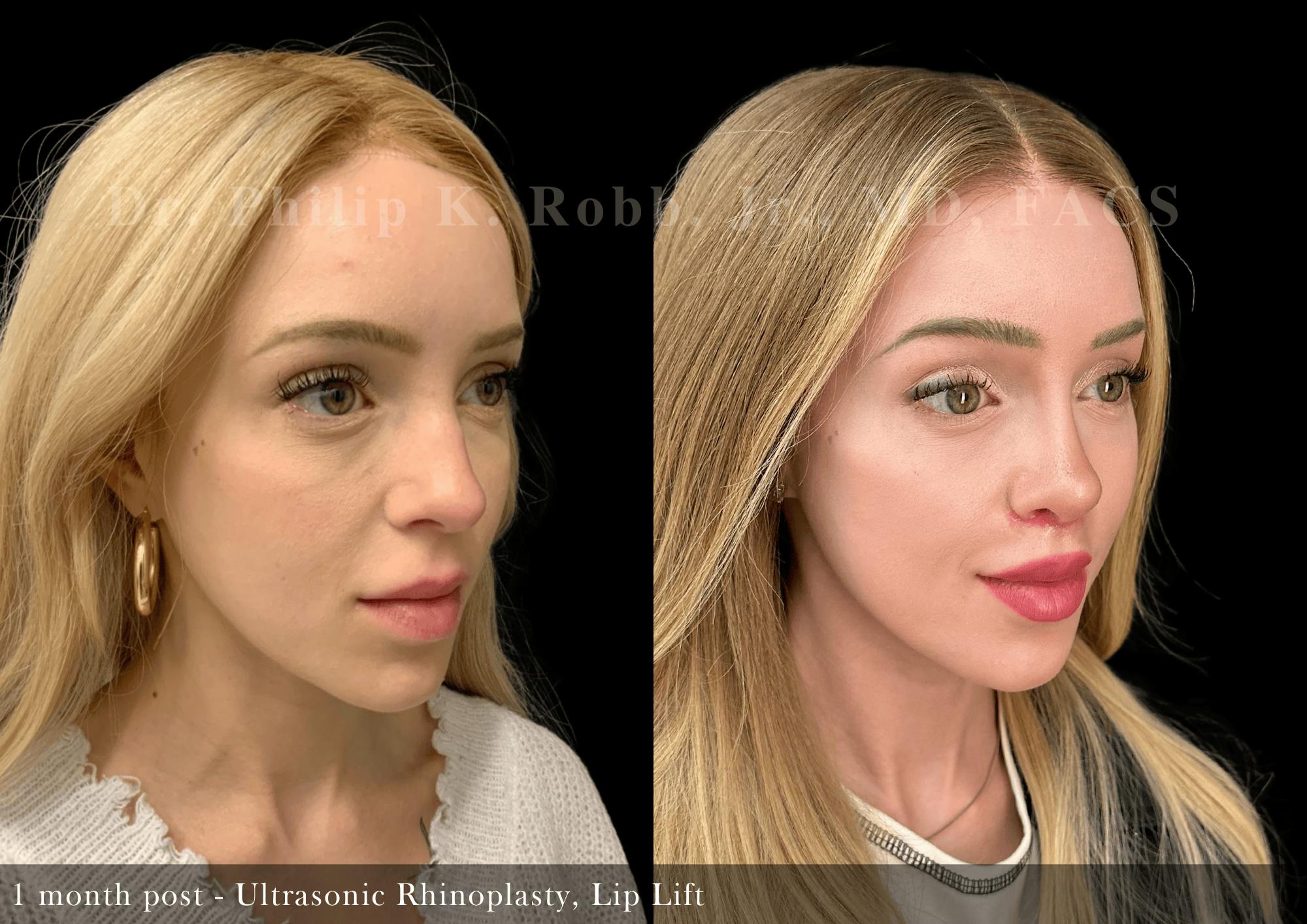 Lip Lift Before & After Gallery - Patient 236385 - Image 5