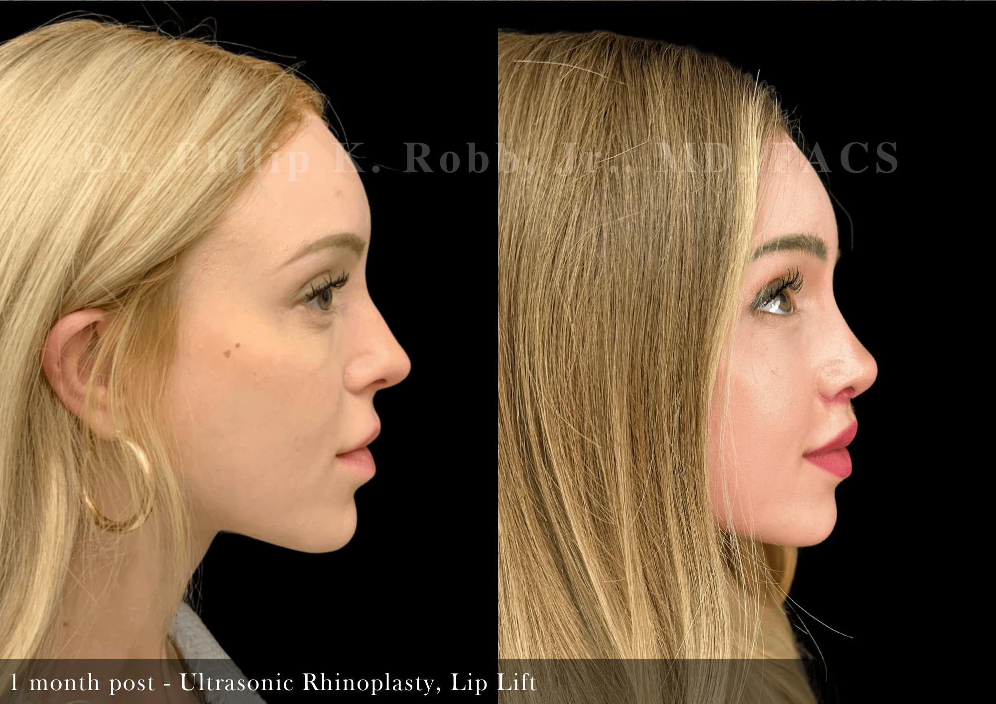 Lip Lift Before & After Gallery - Patient 236385 - Image 4