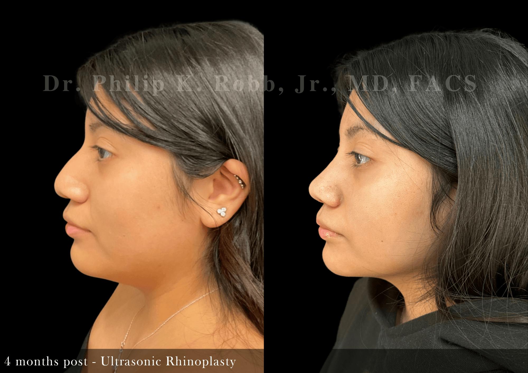 Ultrasonic Rhinoplasty Before & After Gallery - Patient 293715 - Image 5