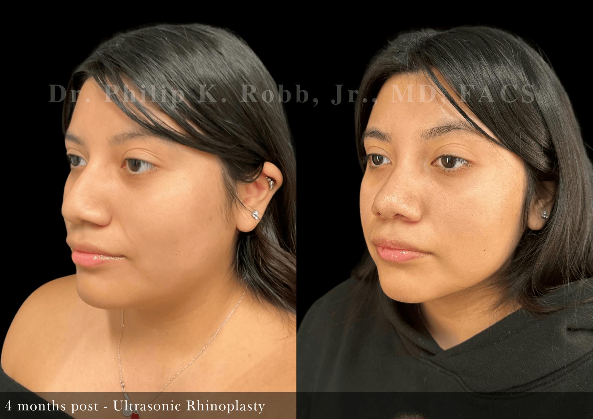 Ultrasonic Rhinoplasty Before & After Gallery - Patient 293715 - Image 4