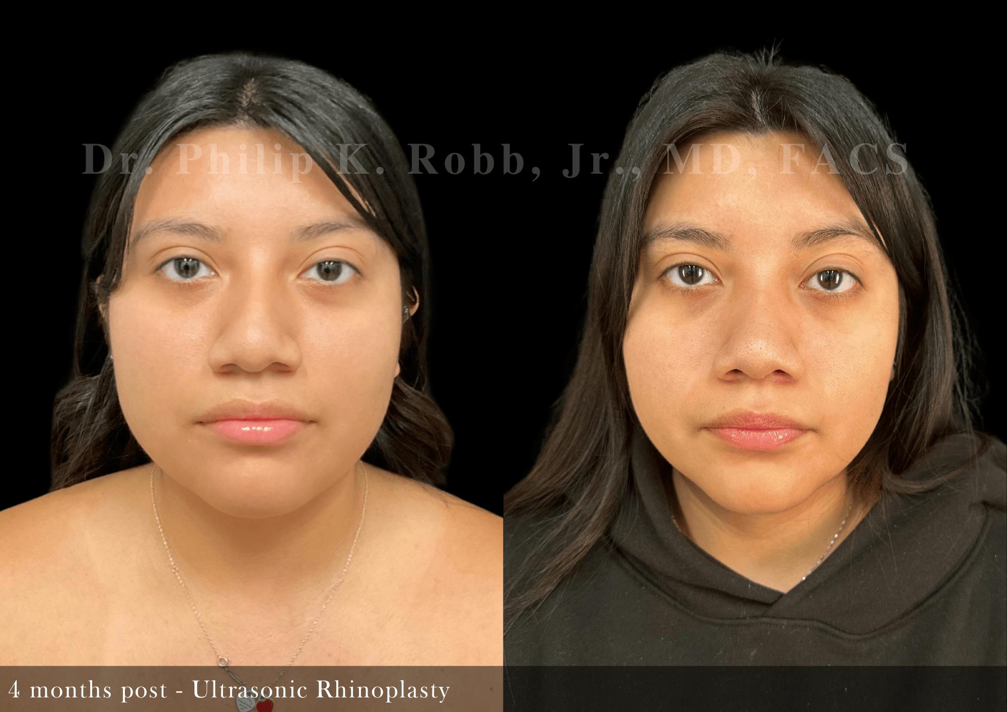 Ultrasonic Rhinoplasty Before & After Gallery - Patient 293715 - Image 3