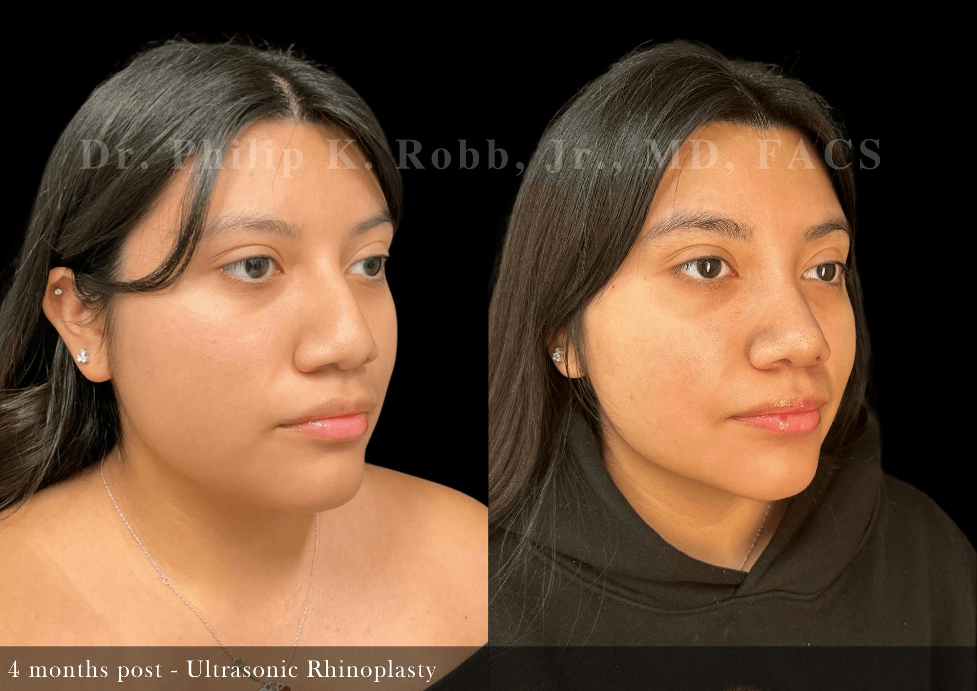 Ultrasonic Rhinoplasty Before & After Gallery - Patient 293715 - Image 2