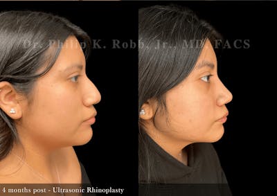 Ultrasonic Rhinoplasty Before & After Gallery - Patient 293715 - Image 1