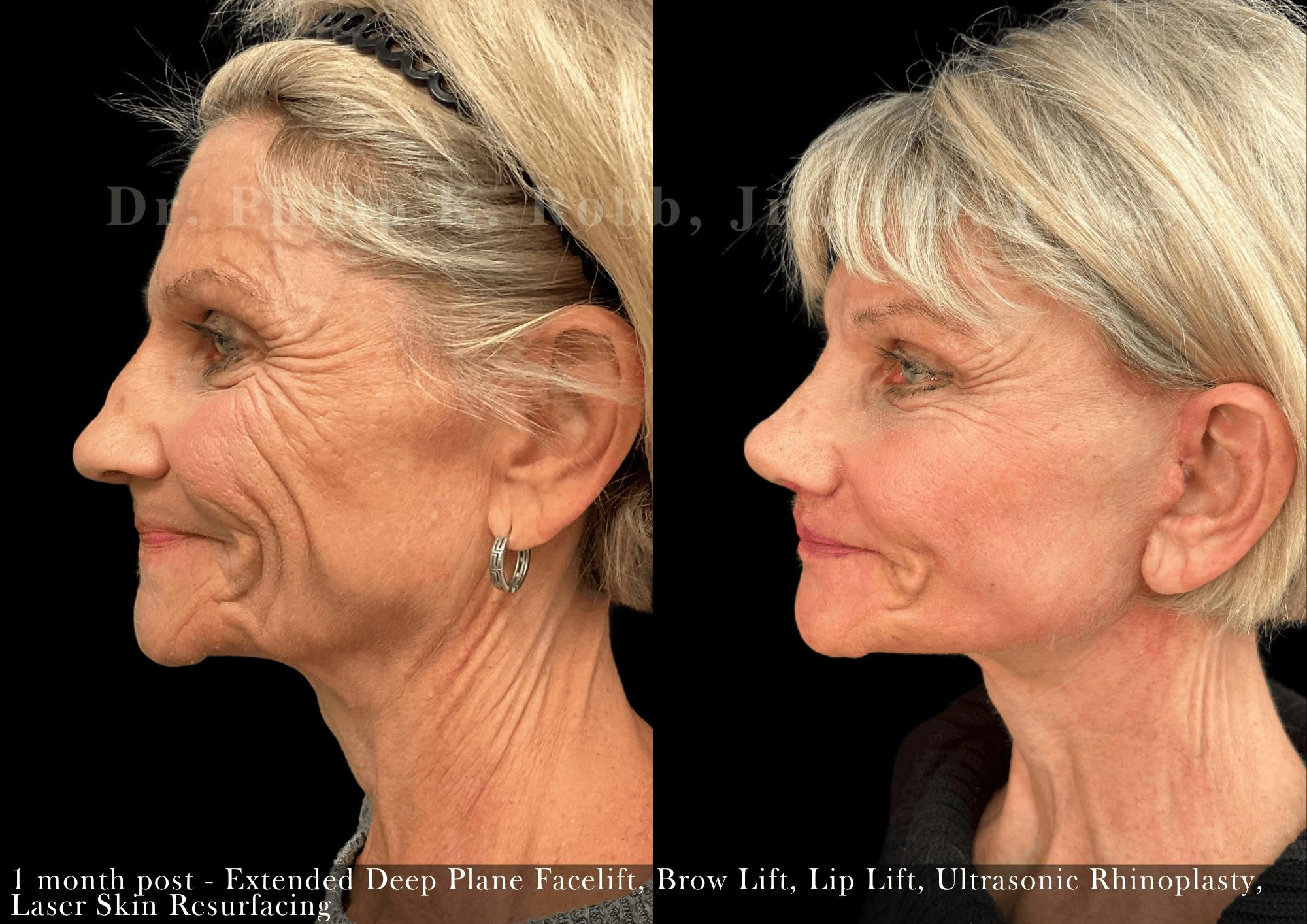 Facelift Before & After Gallery - Patient 936482 - Image 3
