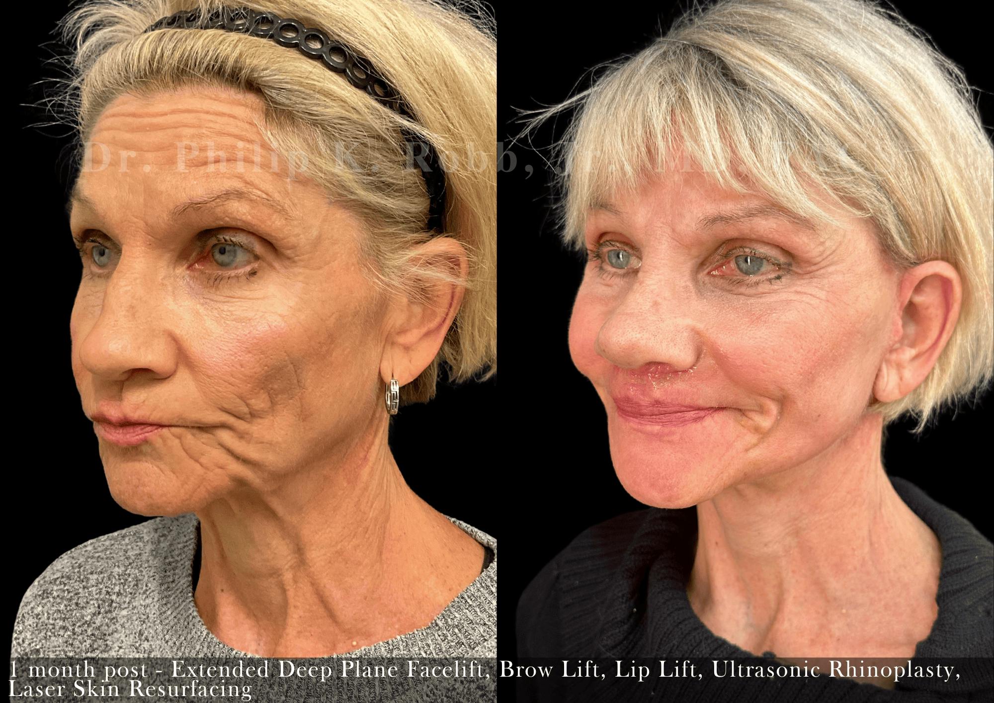 Lip Lift Before & After Gallery - Patient 148412 - Image 5