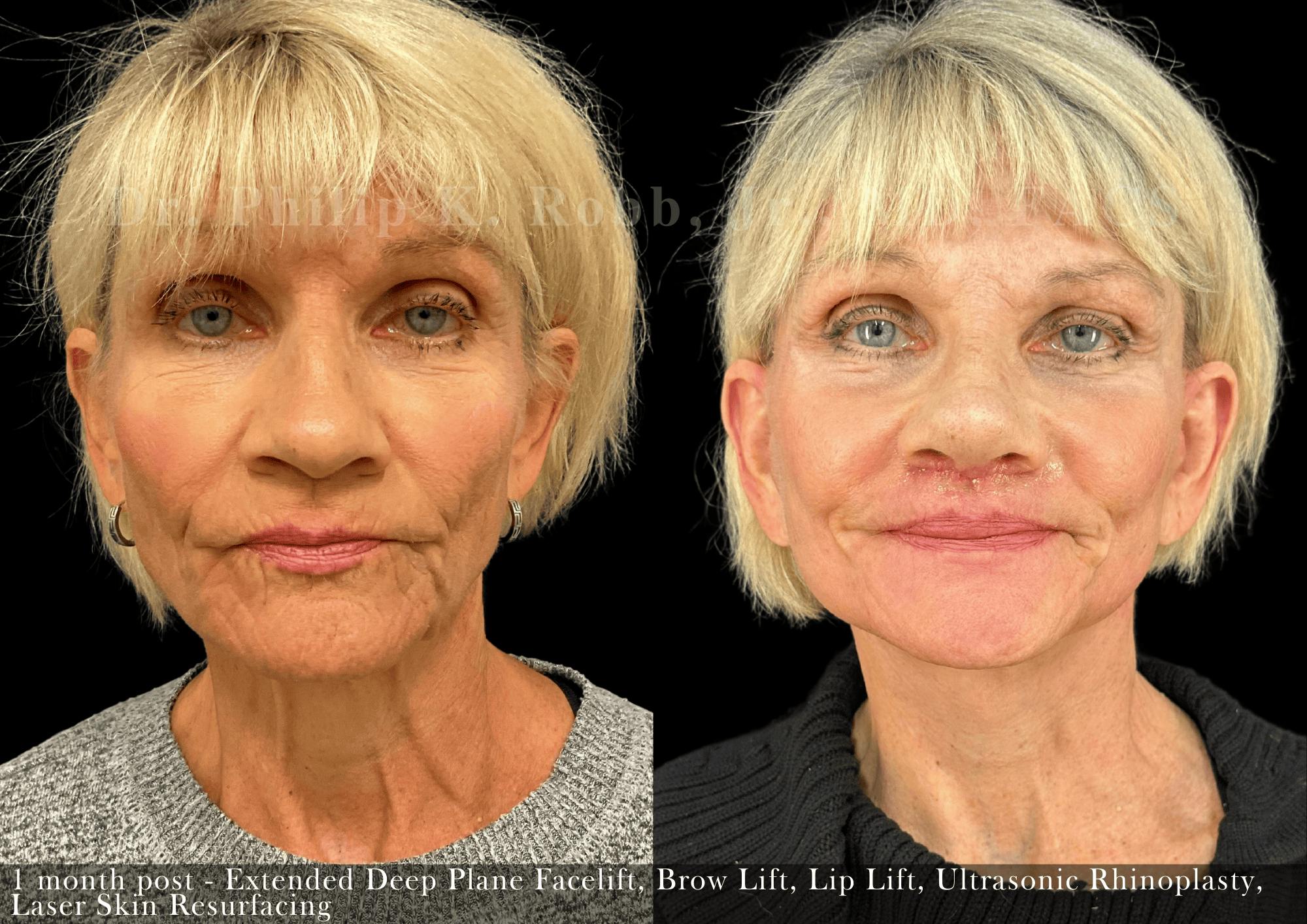 Facelift Before & After Gallery - Patient 936482 - Image 1