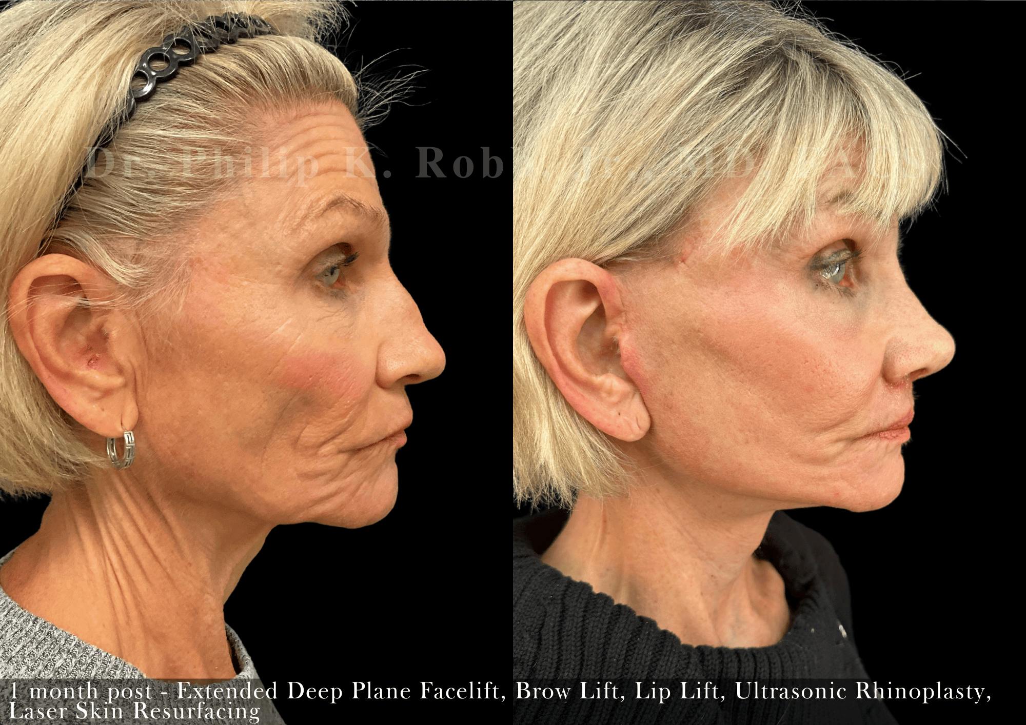 Laser Skin Resurfacing Before & After Gallery - Patient 148201 - Image 3