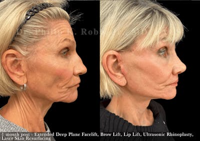Ultrasonic Rhinoplasty Before & After Gallery - Patient 154060 - Image 1