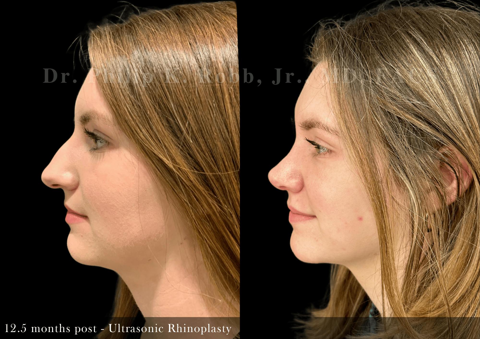 Ultrasonic Rhinoplasty Before & After Gallery - Patient 747921 - Image 5