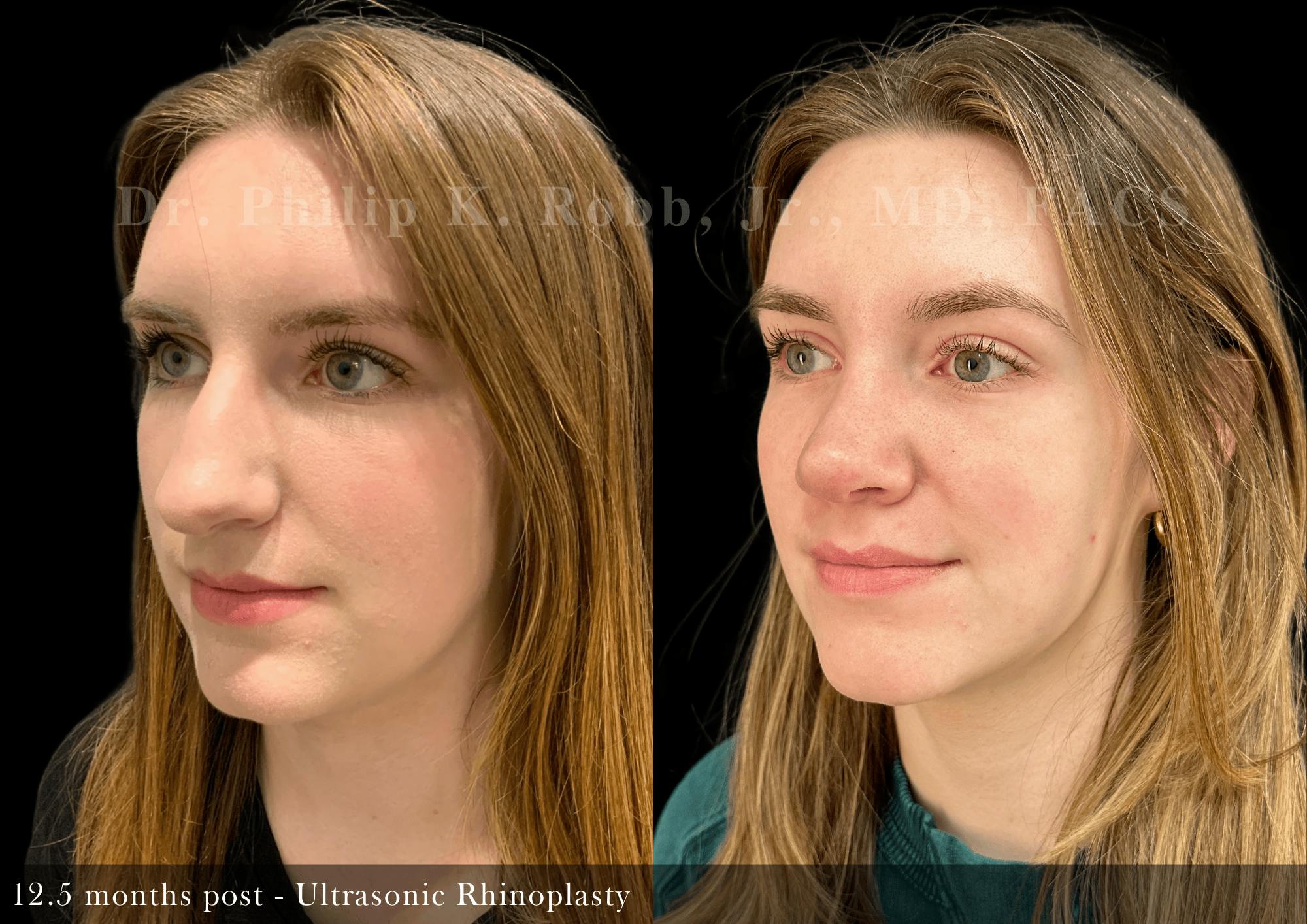 Ultrasonic Rhinoplasty Before & After Gallery - Patient 747921 - Image 4