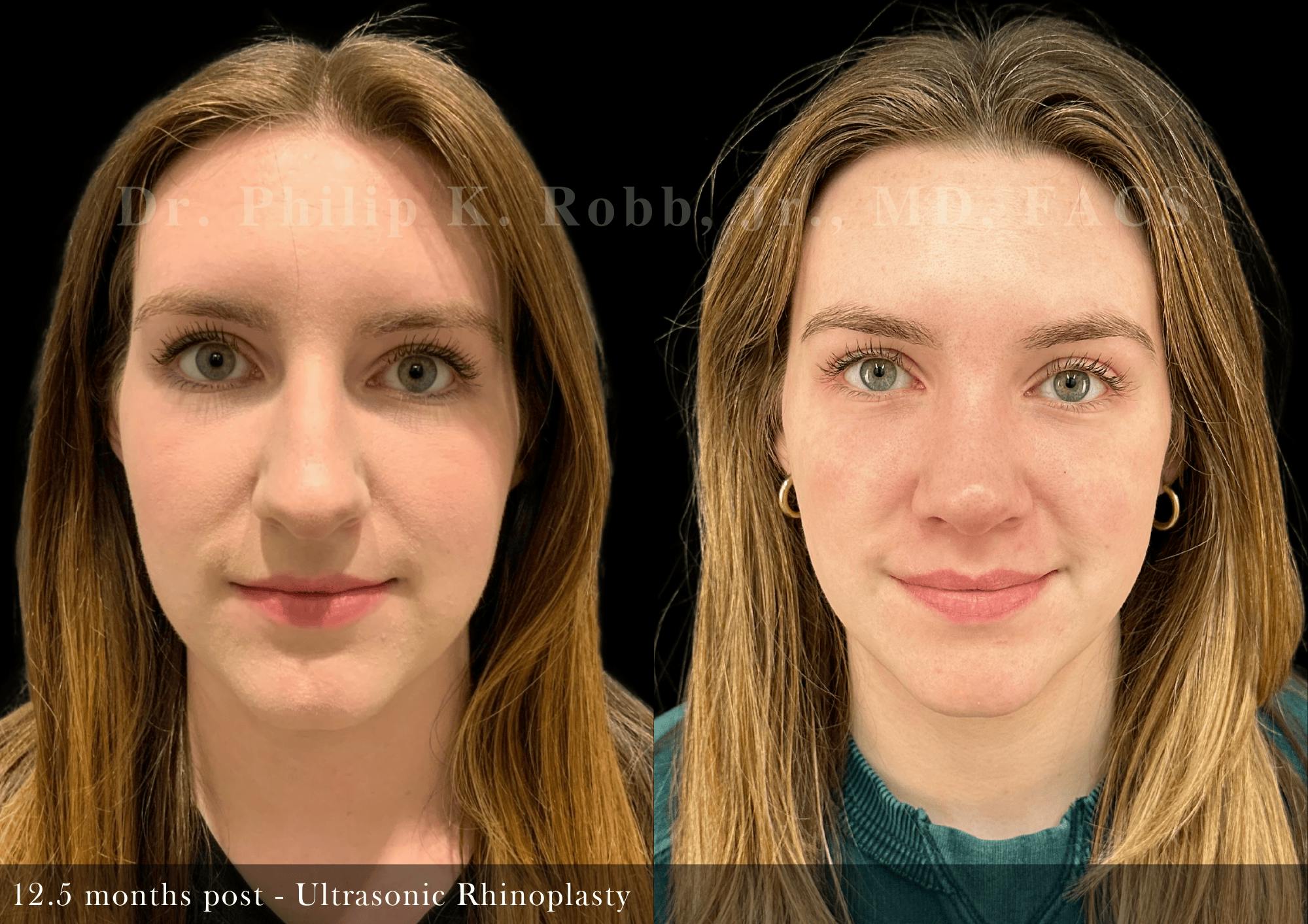 Ultrasonic Rhinoplasty Before & After Gallery - Patient 747921 - Image 3