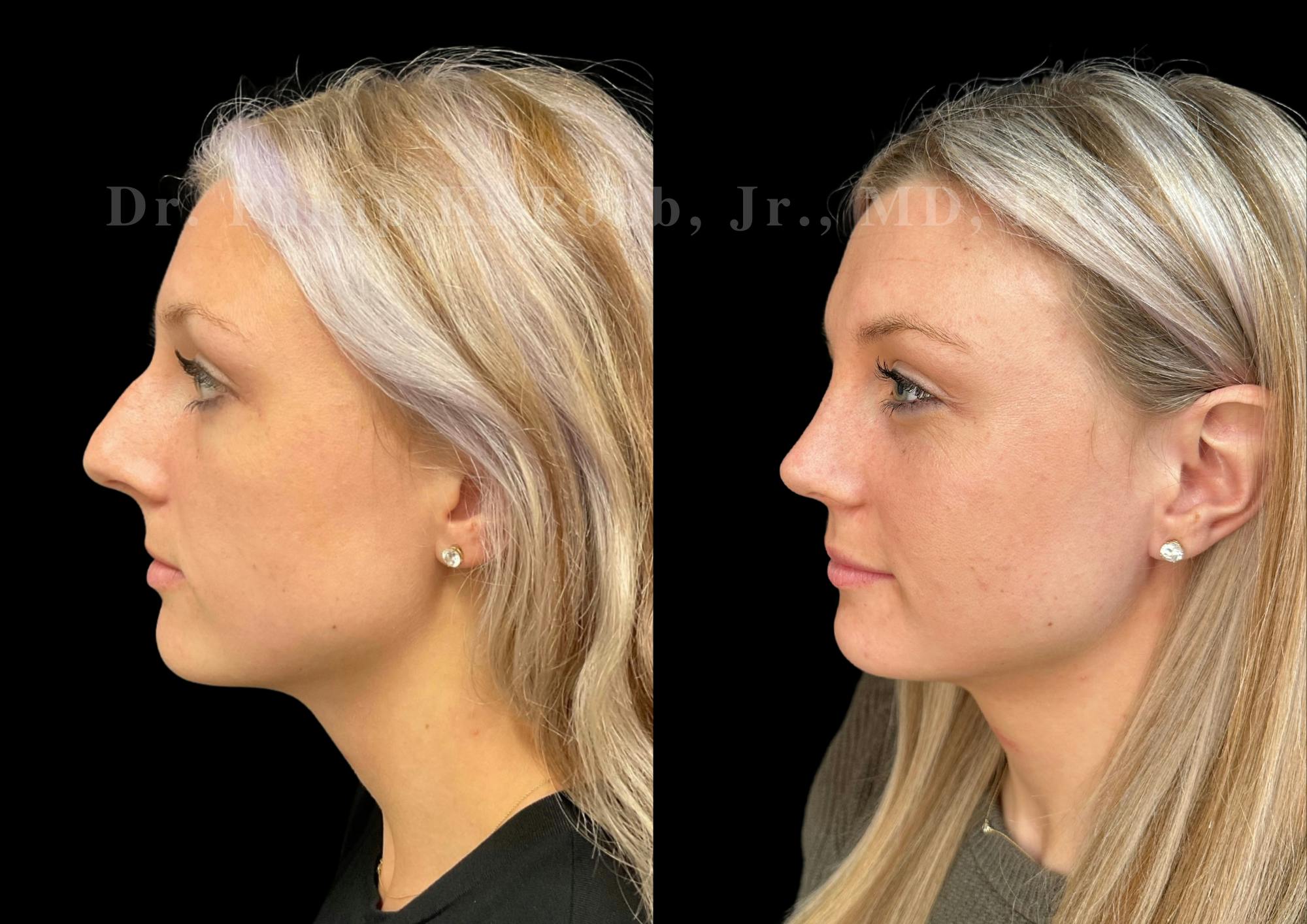 Ultrasonic Rhinoplasty Before & After Gallery - Patient 337839 - Image 5