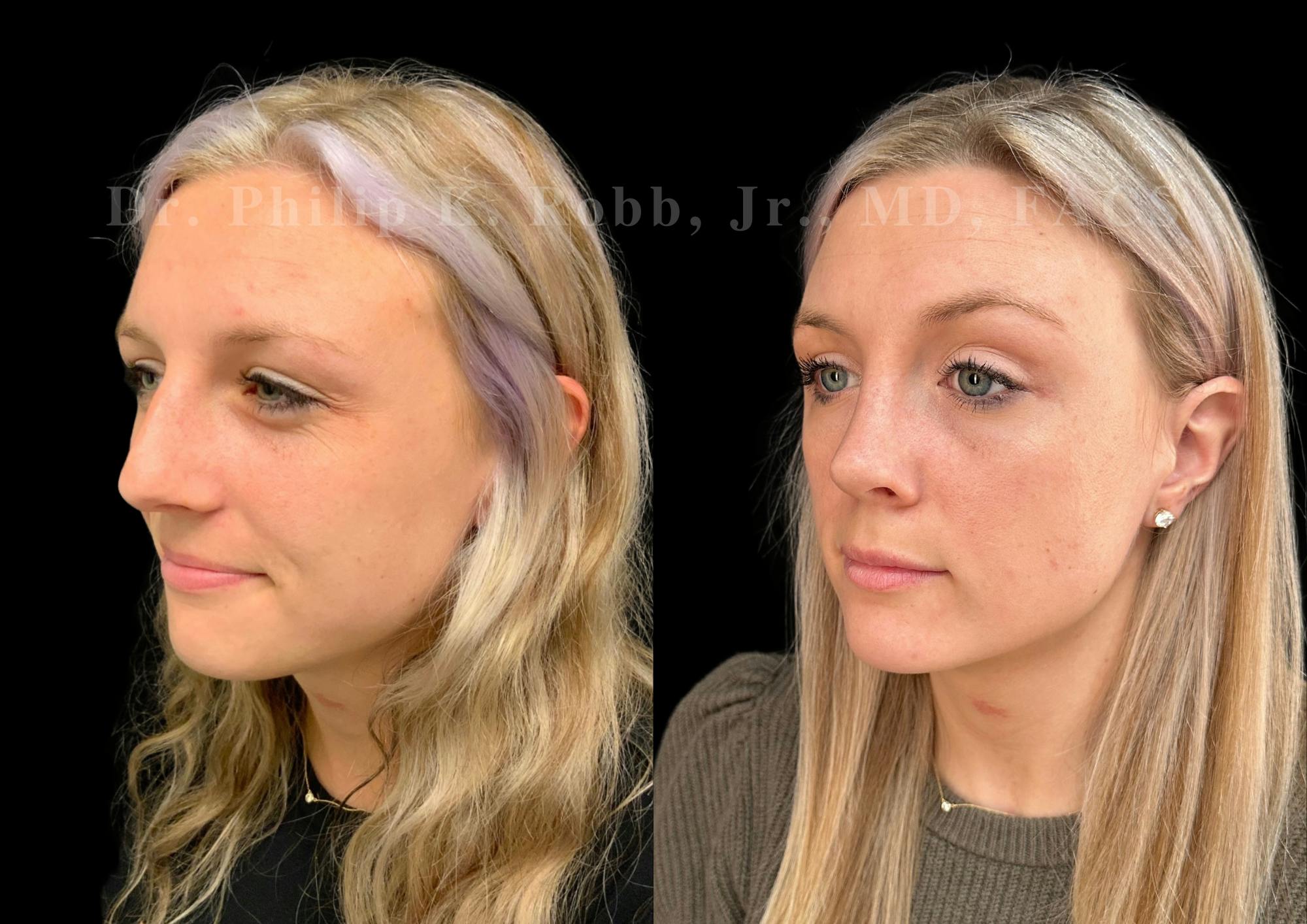 Ultrasonic Rhinoplasty Before & After Gallery - Patient 337839 - Image 4
