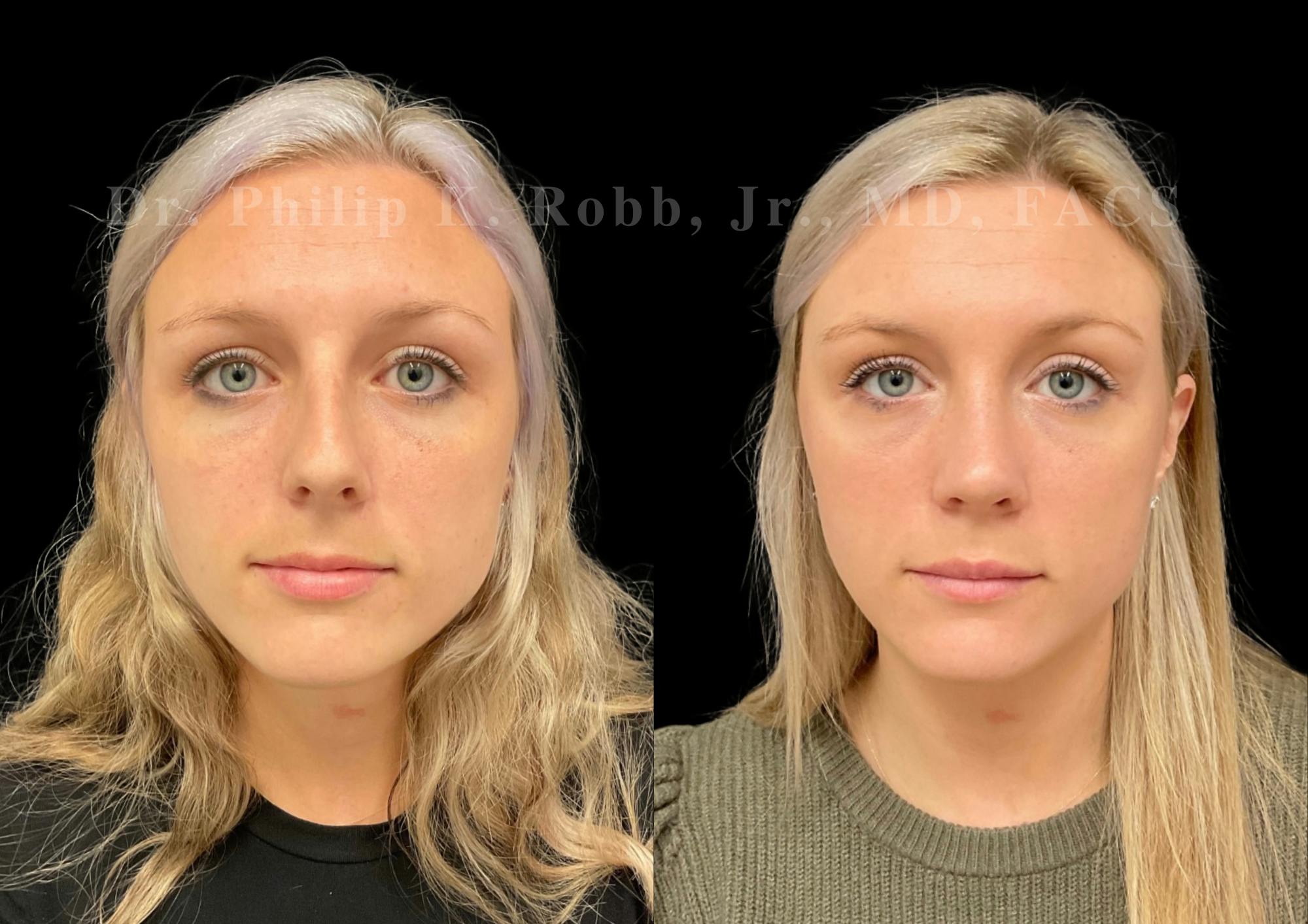 Ultrasonic Rhinoplasty Before & After Gallery - Patient 337839 - Image 3