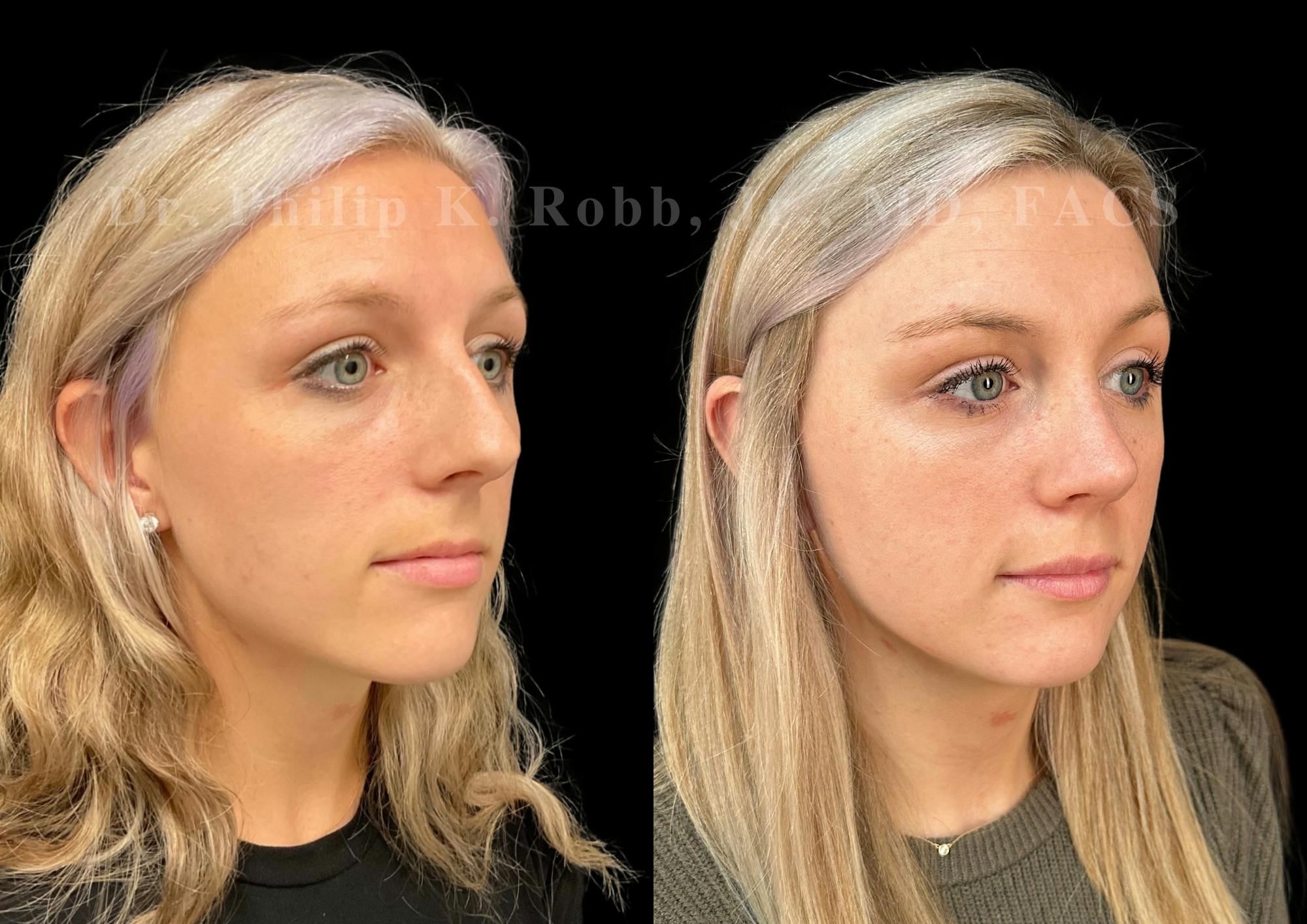 Ultrasonic Rhinoplasty Before & After Gallery - Patient 337839 - Image 2
