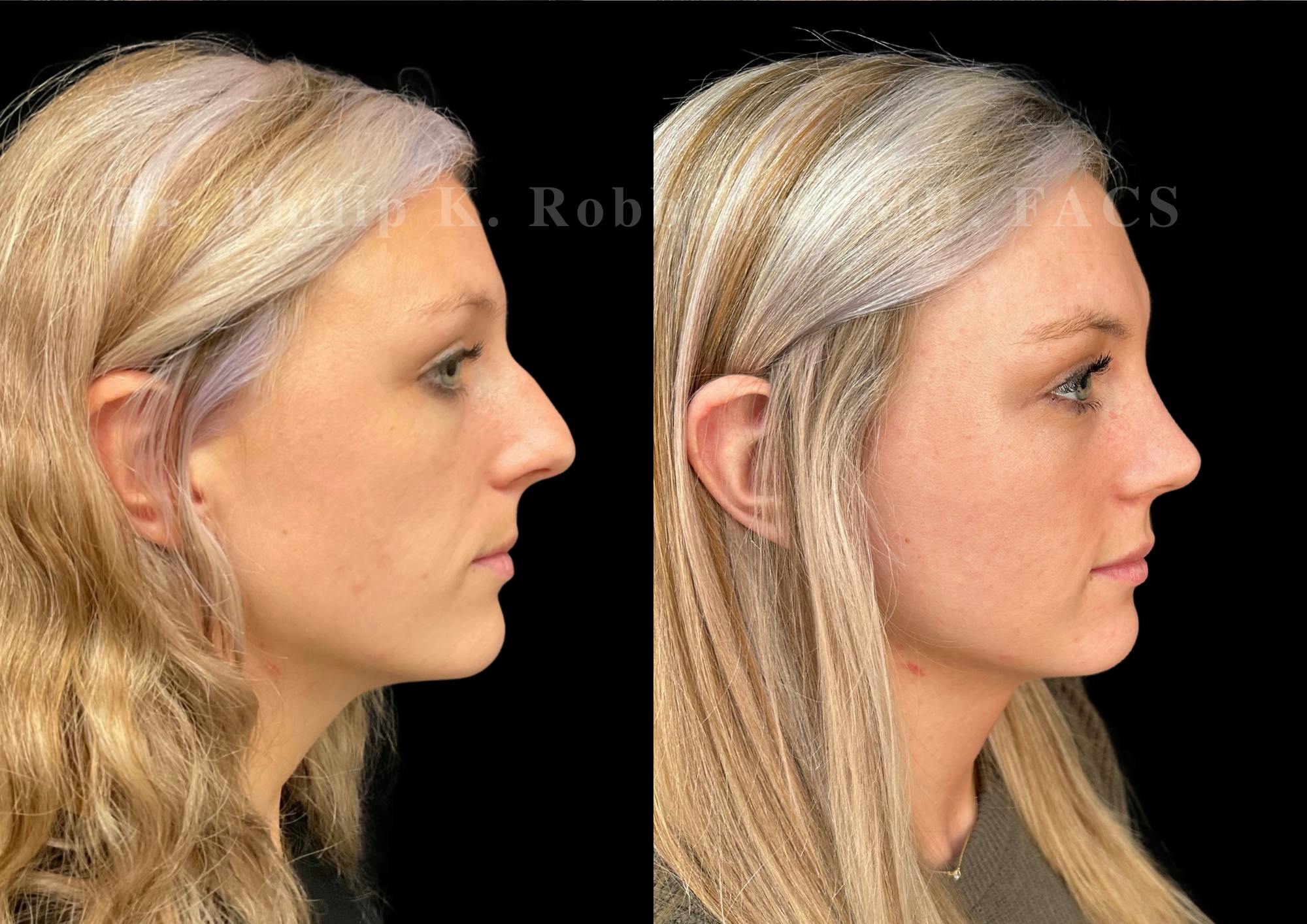 Ultrasonic Rhinoplasty Before & After Gallery - Patient 337839 - Image 1