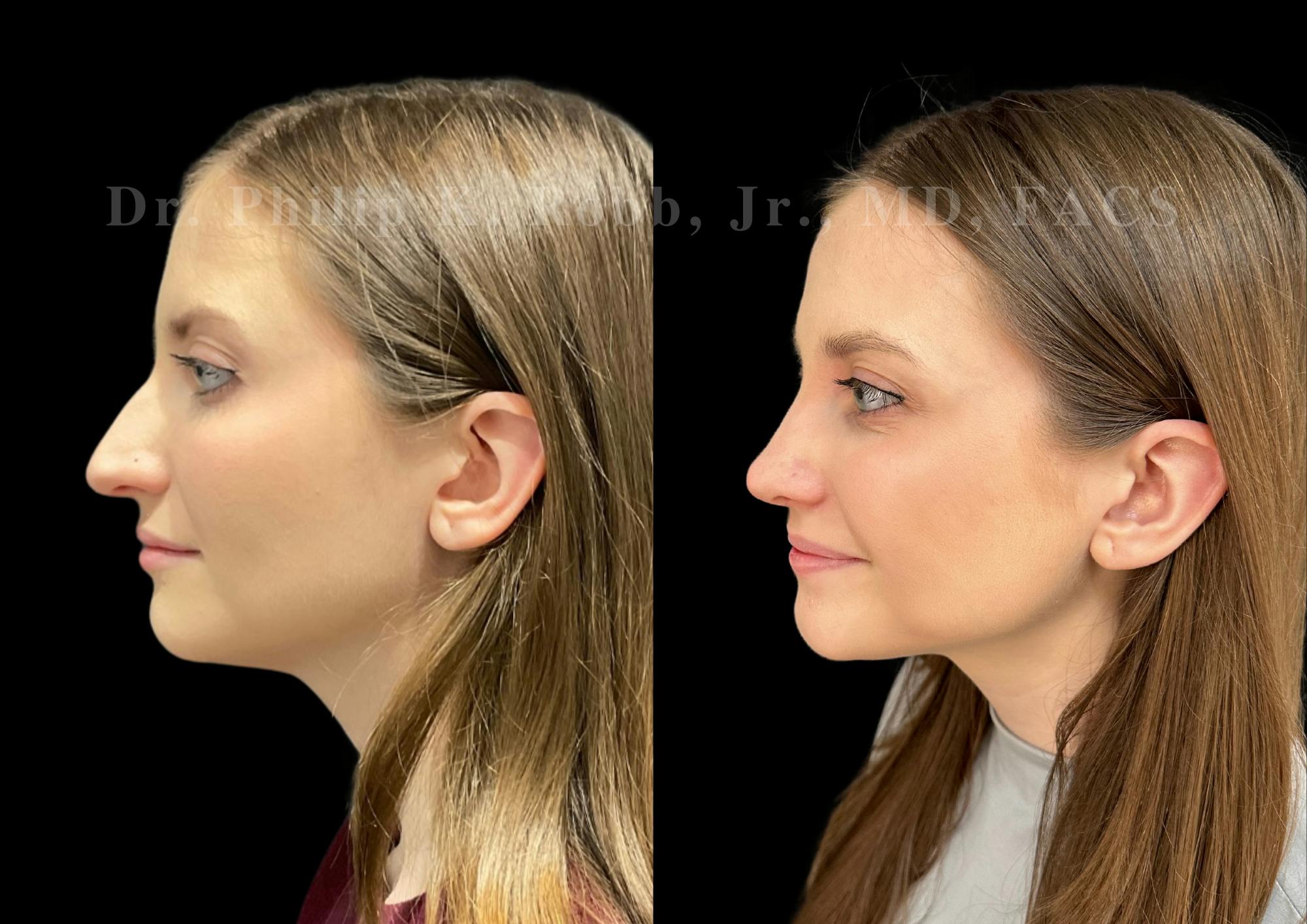 Ultrasonic Rhinoplasty Before & After Gallery - Patient 208036 - Image 5