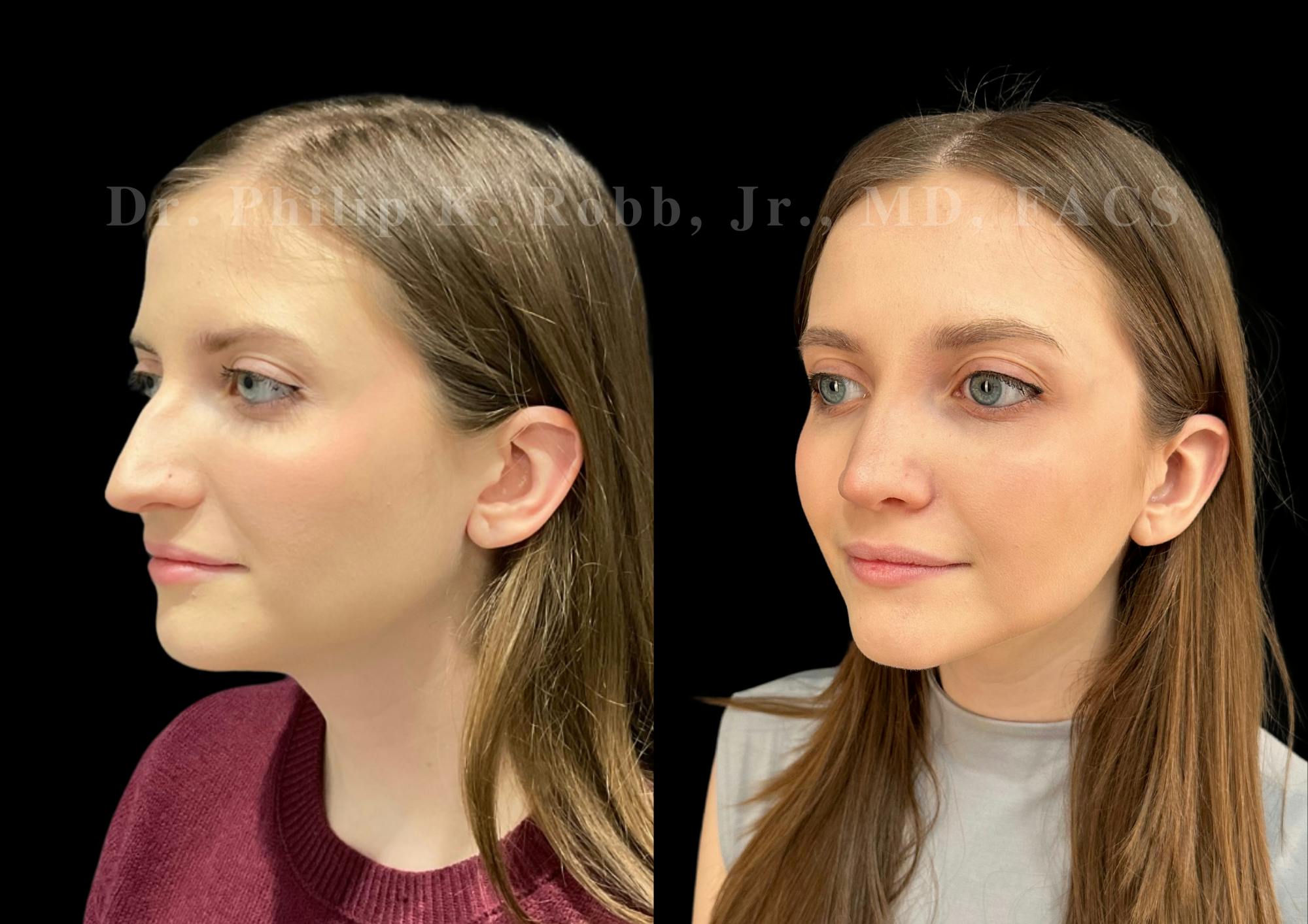 Ultrasonic Rhinoplasty Before & After Gallery - Patient 208036 - Image 4