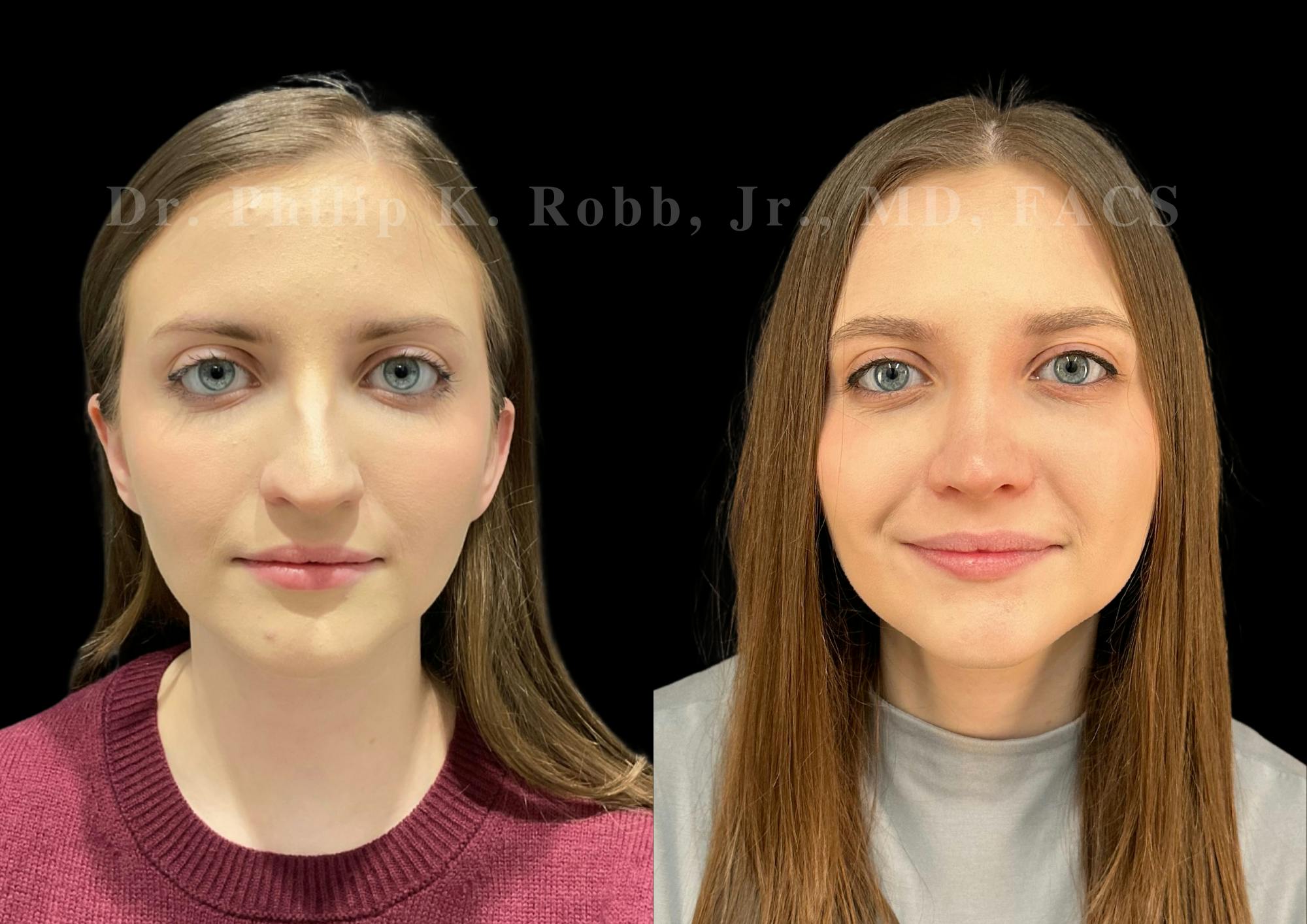 Ultrasonic Rhinoplasty Before & After Gallery - Patient 208036 - Image 3