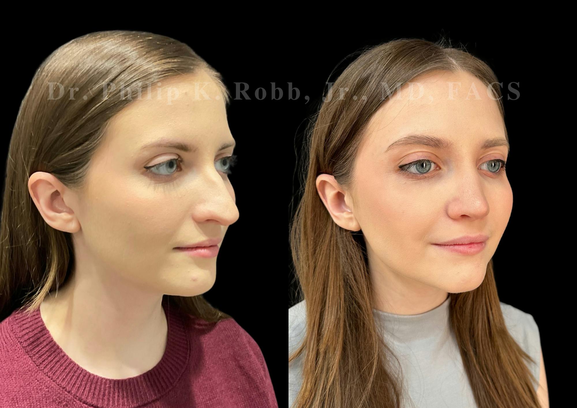 Ultrasonic Rhinoplasty Before & After Gallery - Patient 208036 - Image 2