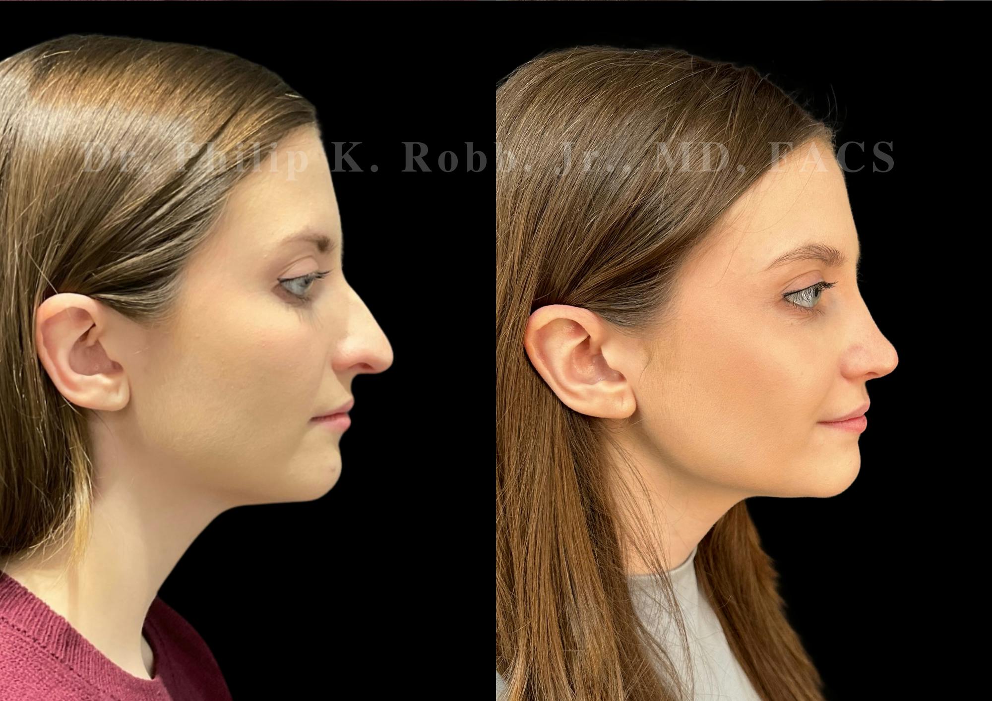 Ultrasonic Rhinoplasty Before & After Gallery - Patient 208036 - Image 1