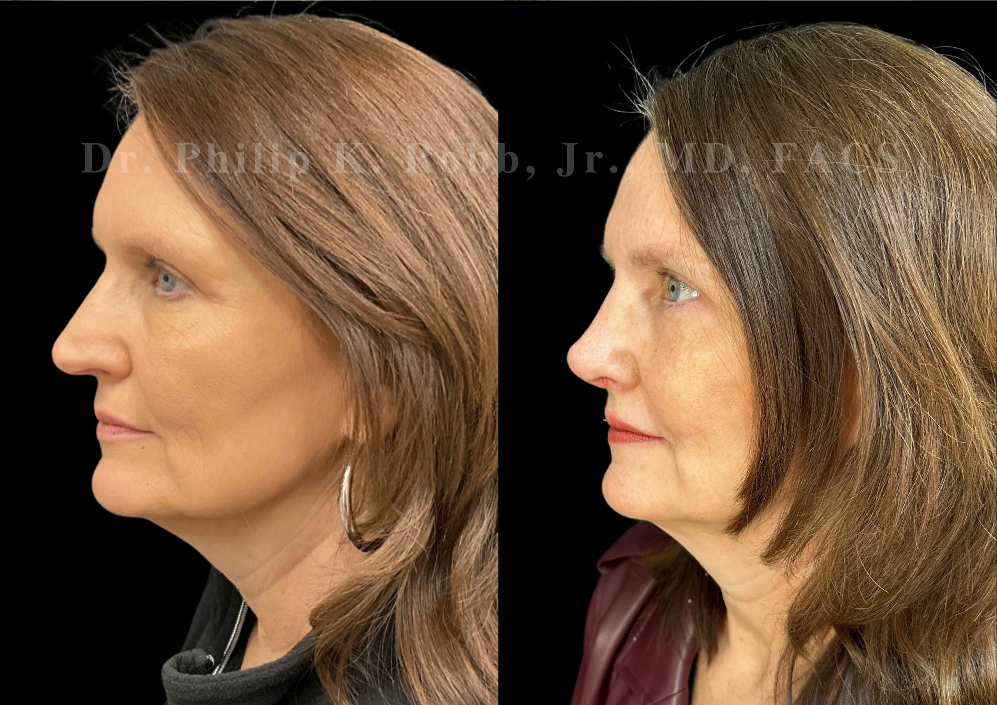 Ultrasonic Rhinoplasty Before & After Gallery - Patient 224550 - Image 5