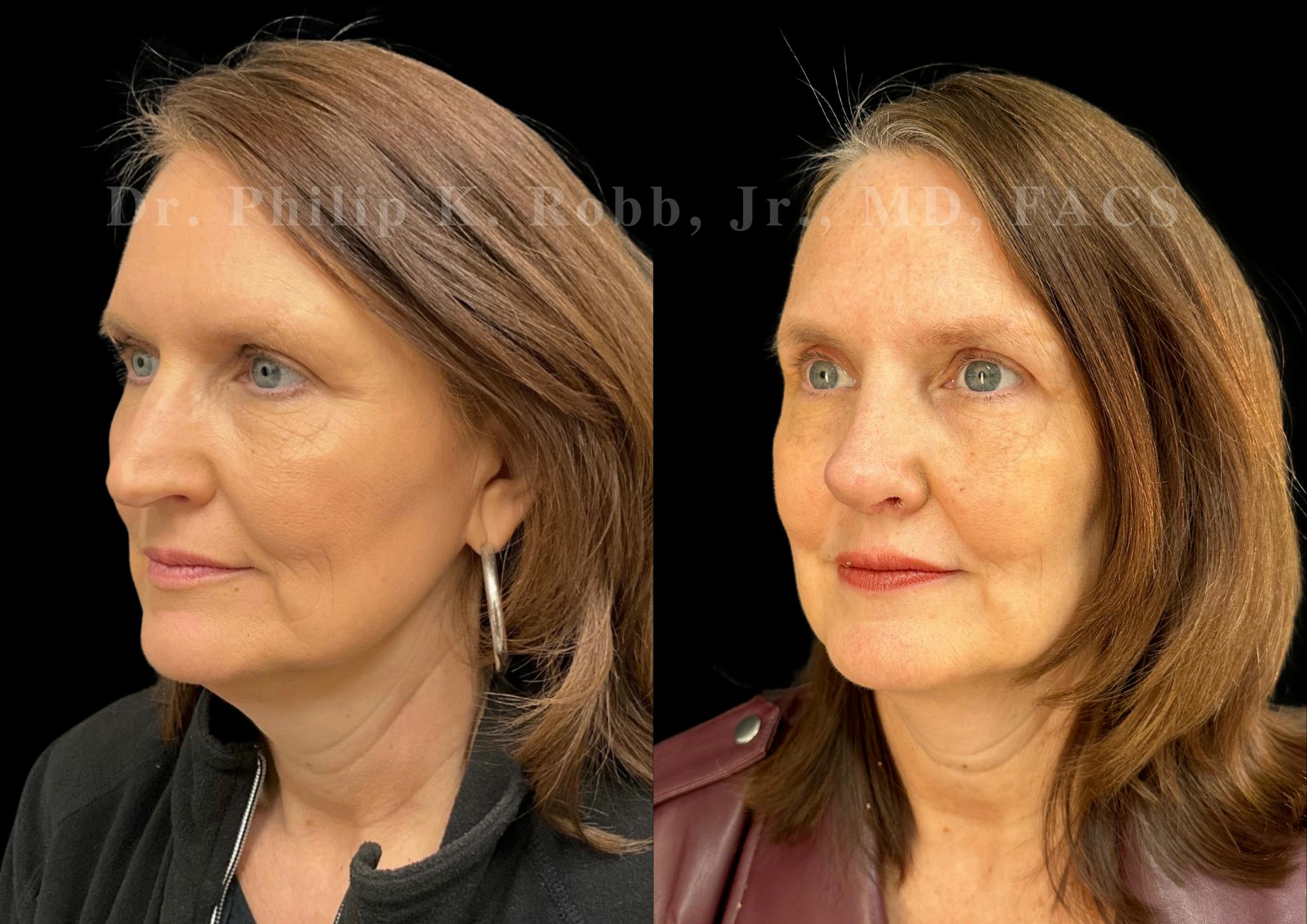 Ultrasonic Rhinoplasty Before & After Gallery - Patient 224550 - Image 4