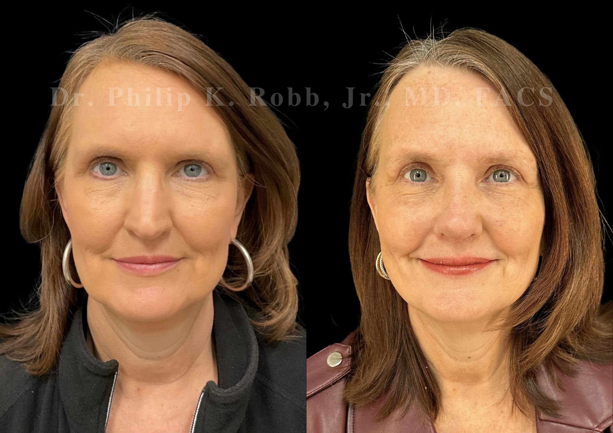 Ultrasonic Rhinoplasty Before & After Gallery - Patient 224550 - Image 3