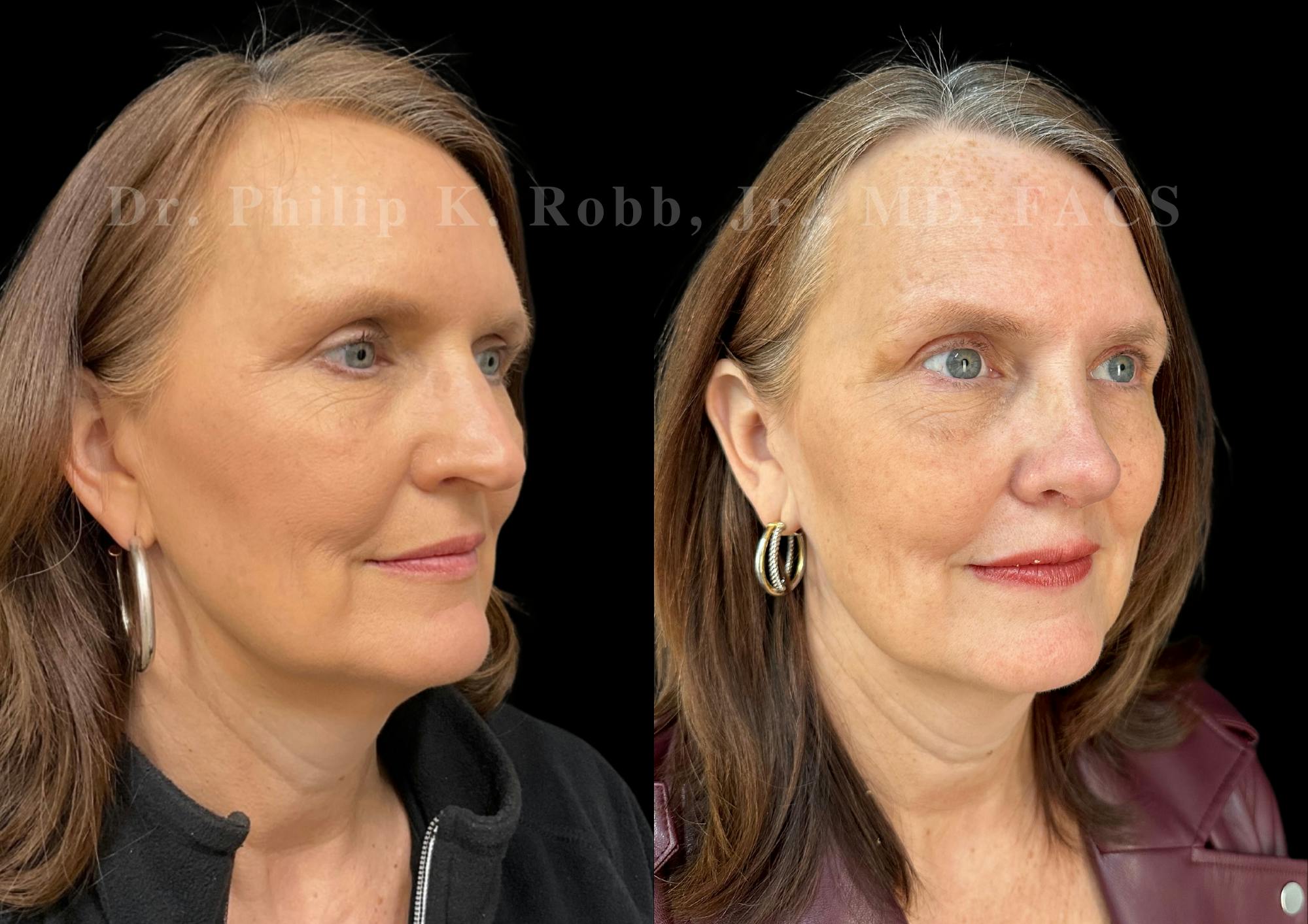 Ultrasonic Rhinoplasty Before & After Gallery - Patient 224550 - Image 2