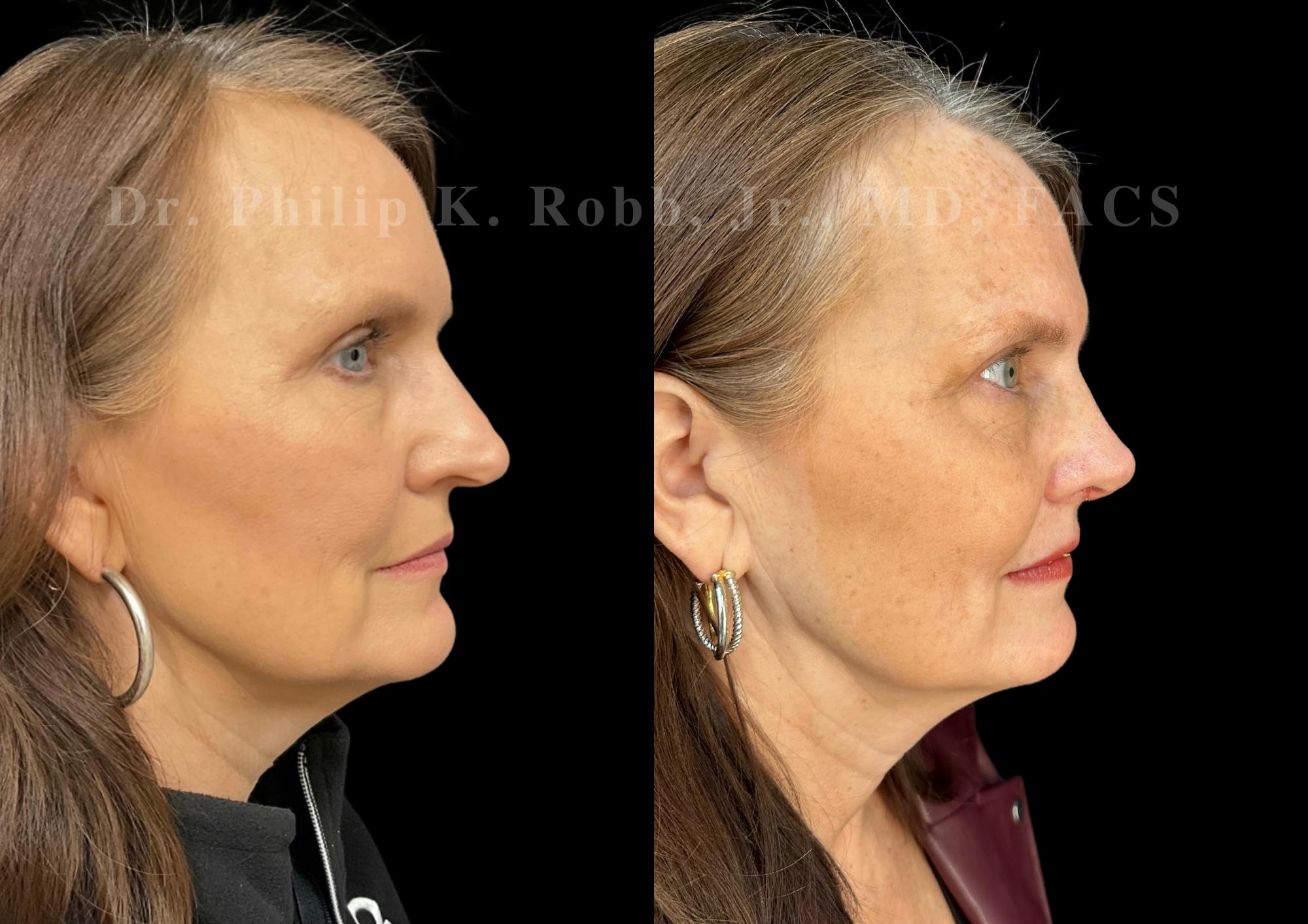 Ultrasonic Rhinoplasty Before & After Gallery - Patient 224550 - Image 1