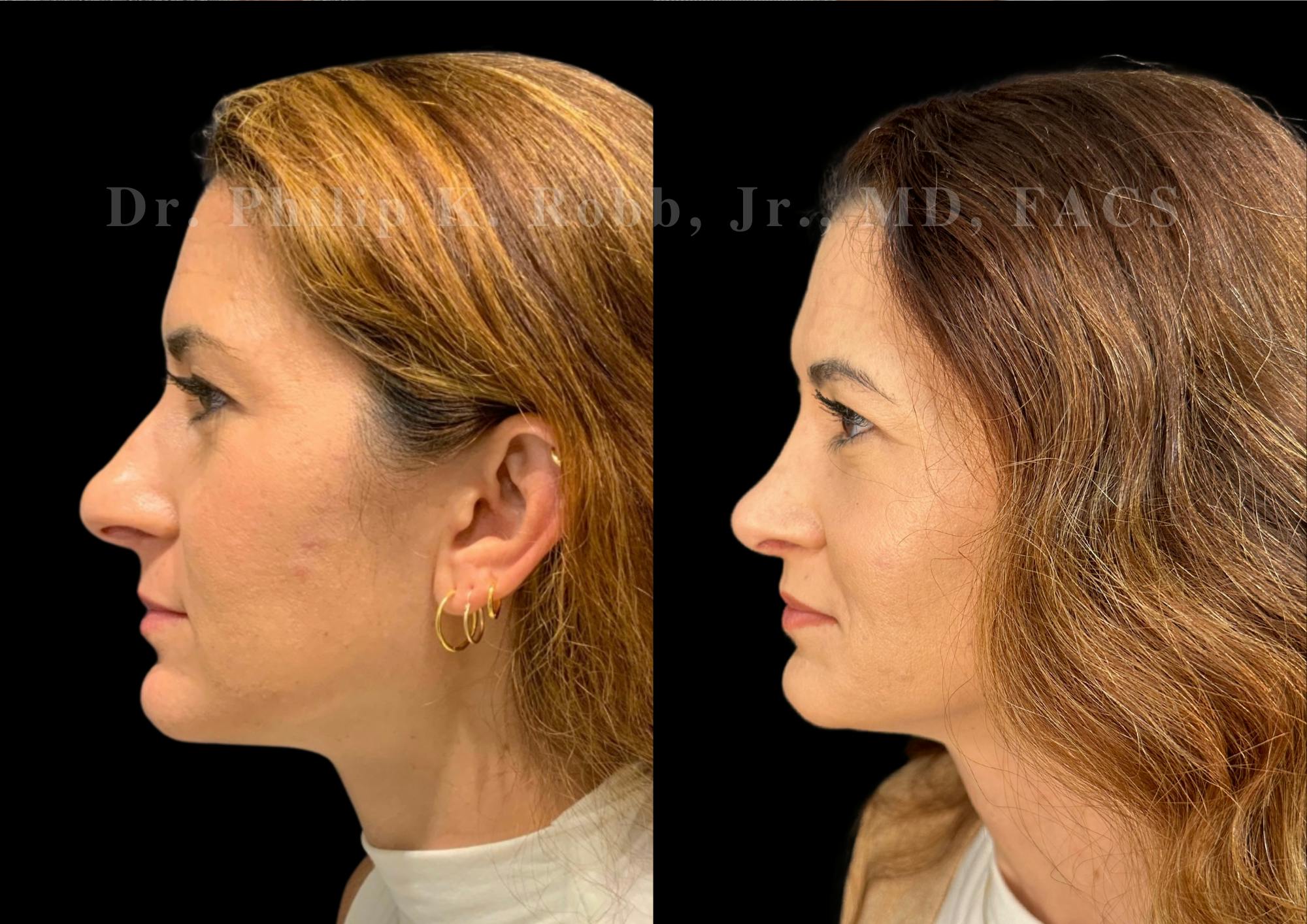 Ultrasonic Rhinoplasty Before & After Gallery - Patient 330936 - Image 5
