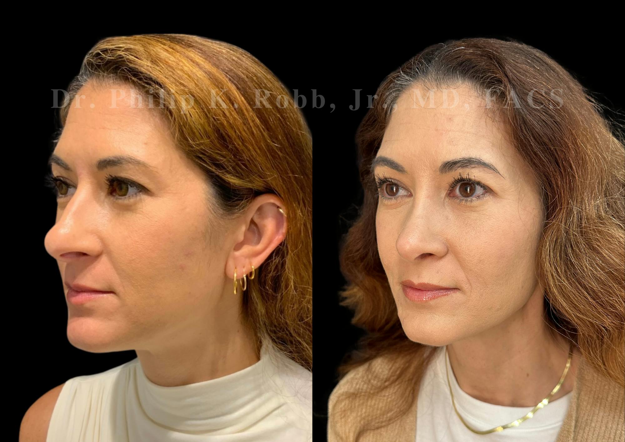Ultrasonic Rhinoplasty Before & After Gallery - Patient 330936 - Image 4