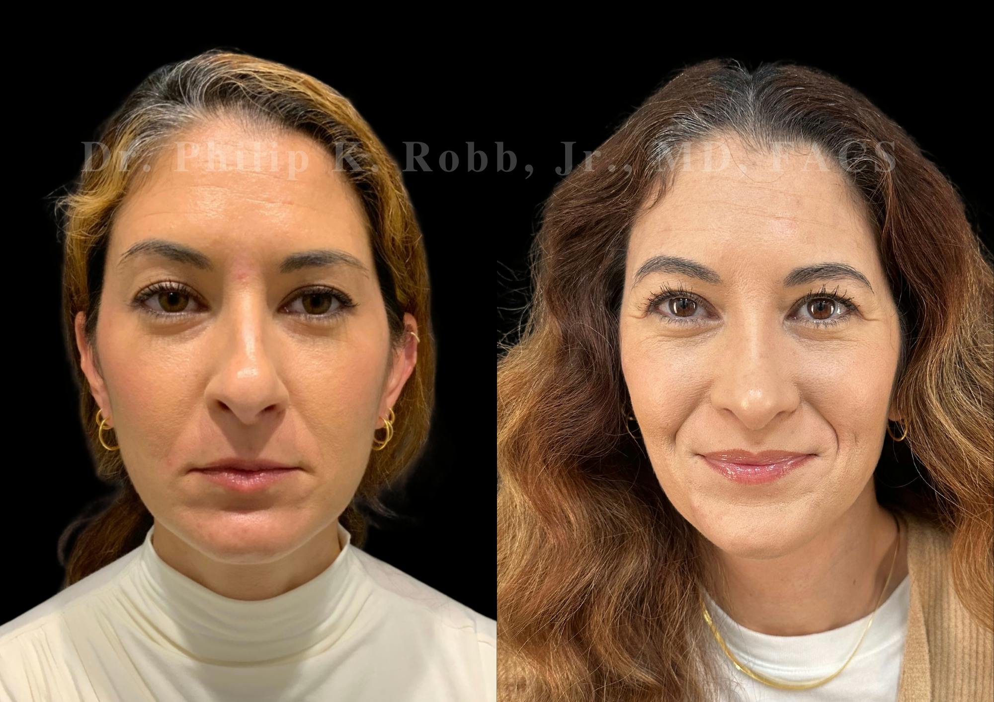 Ultrasonic Rhinoplasty Before & After Gallery - Patient 330936 - Image 3